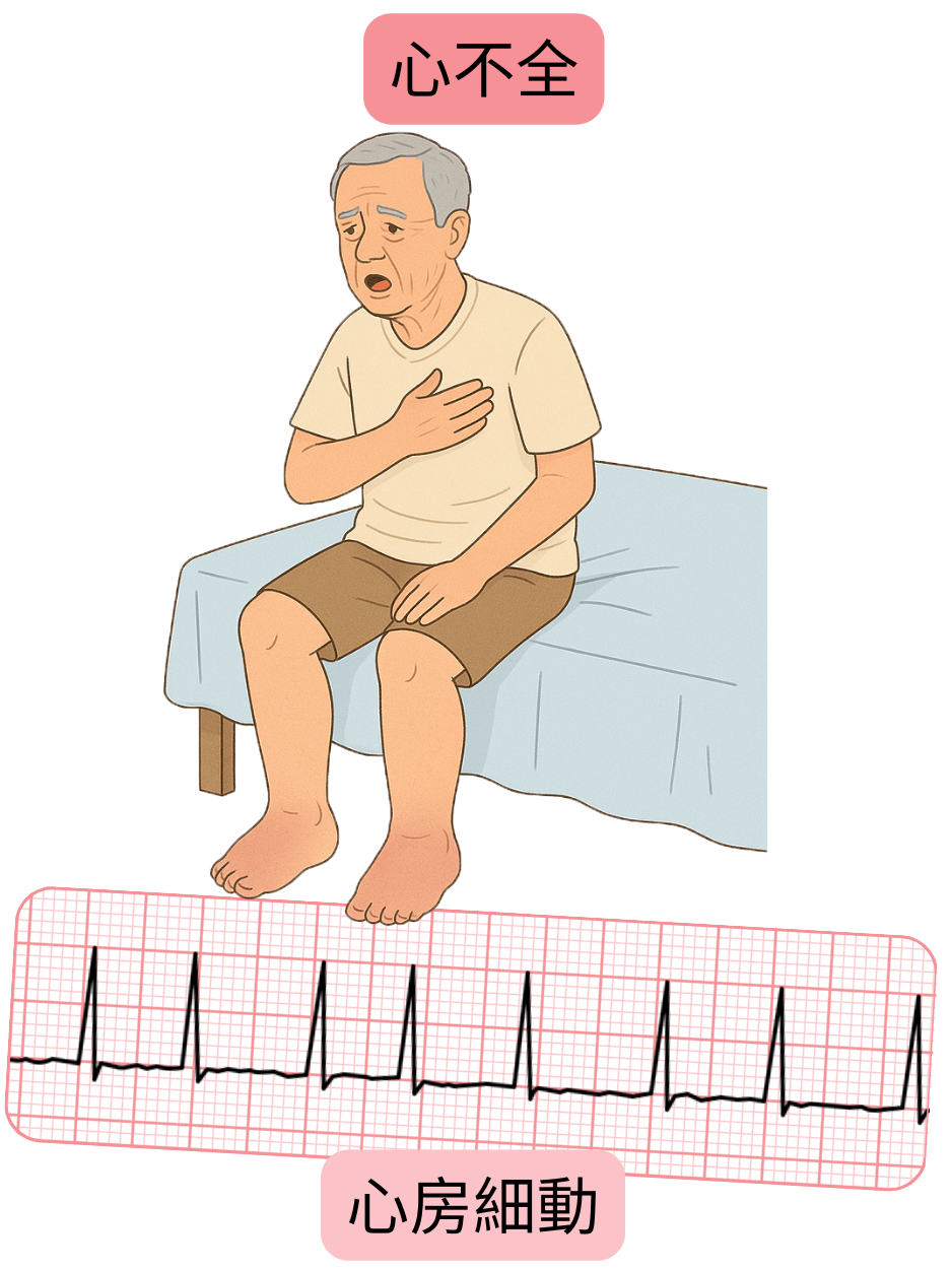心房細動の重要な併存疾患としての心不全を、不整脈の心電図記録とともに示す図。