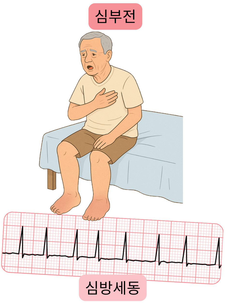 심방세동의 중요한 동반 질환으로서 심부전을 부정맥의 심전도 기록과 함께 보여주는 그림.