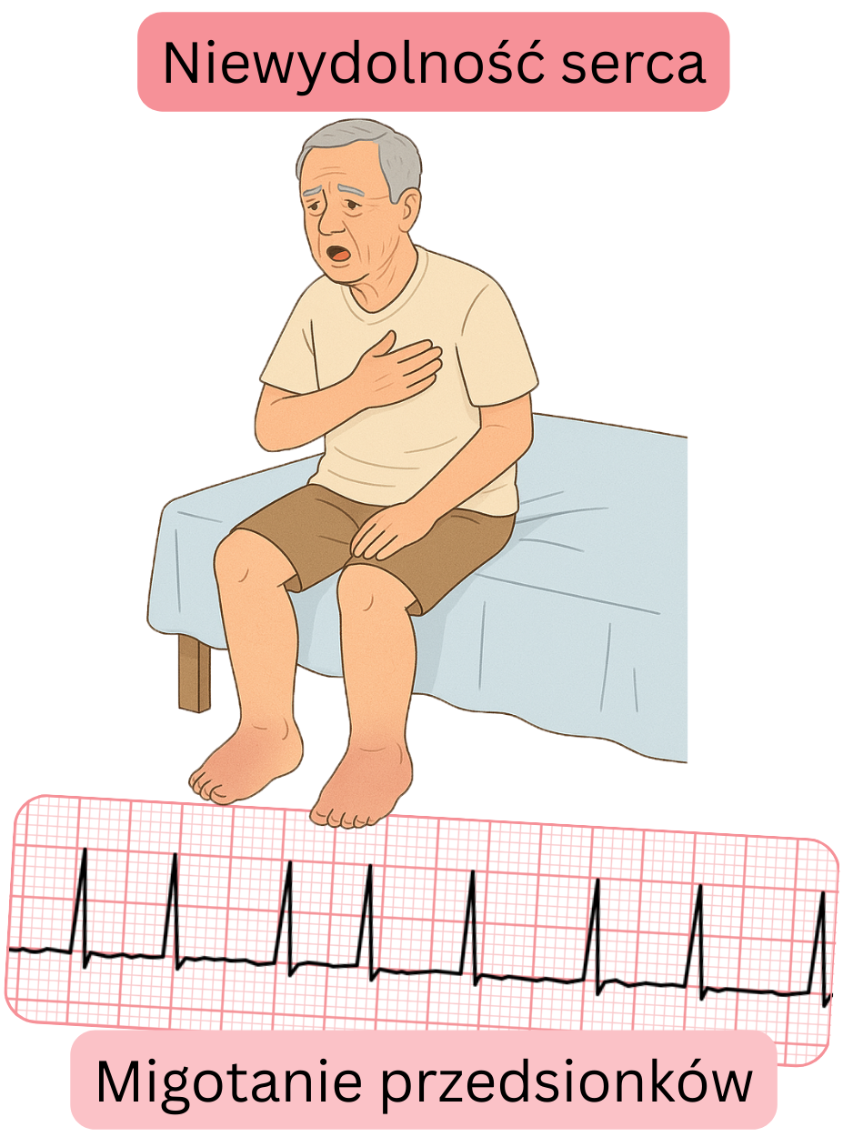 Ilustracja przedstawiająca niewydolność serca jako istotną chorobę współistniejącą migotania przedsionków wraz z zapisem EKG arytmii.