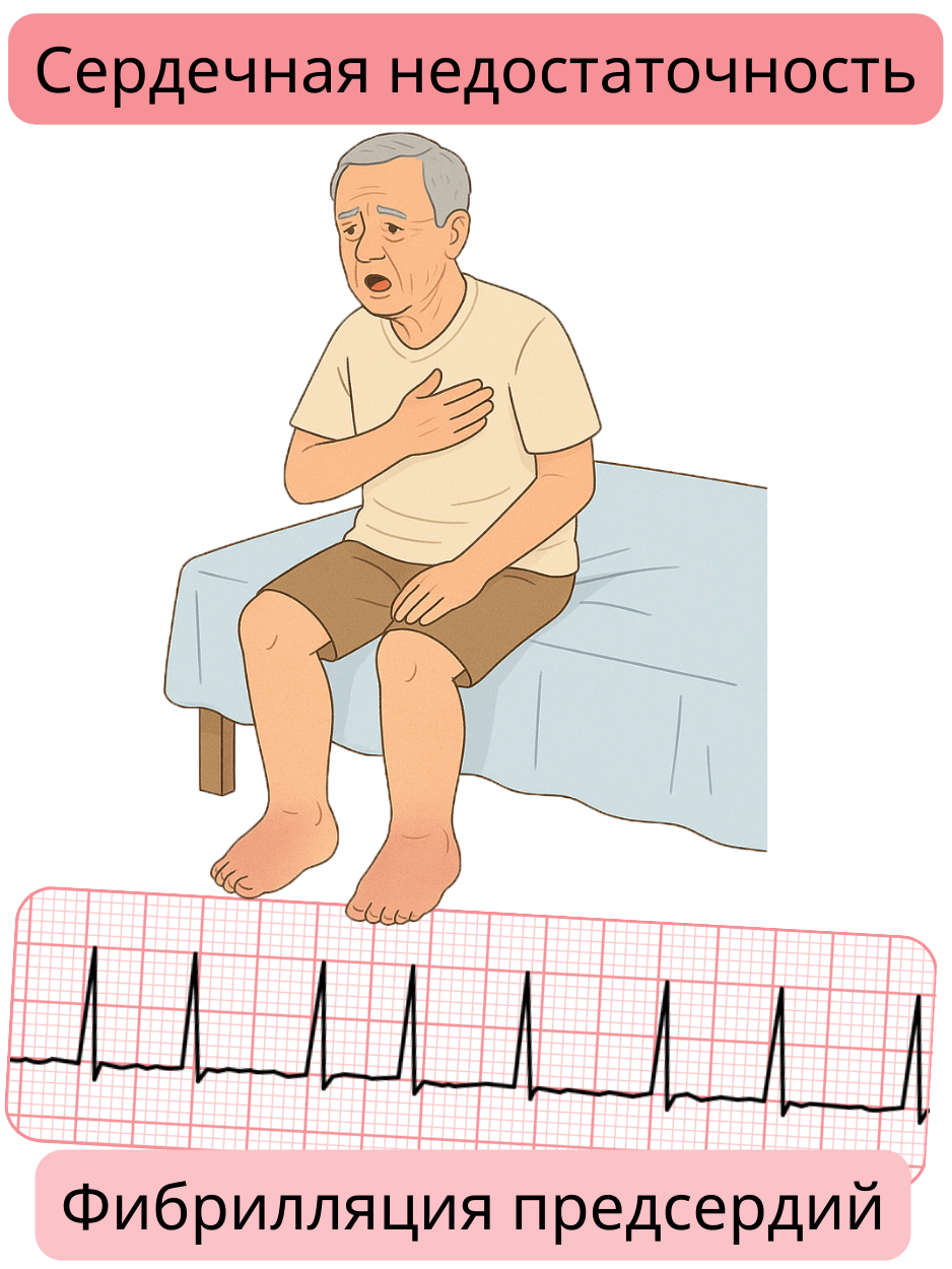Иллюстрация, демонстрирующая сердечную недостаточность как значимую коморбидность фибрилляции предсердий с ЭКГ-записью аритмии.