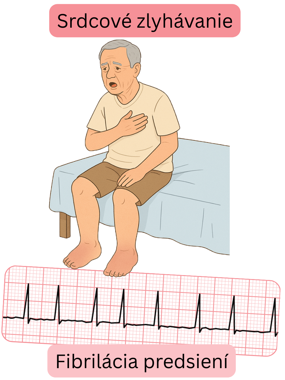 Ilustrácia znázorňujúca srdcové zlyhávanie ako významnú komorbiditu fibrilácie predsiení s EKG záznamom arytmie.