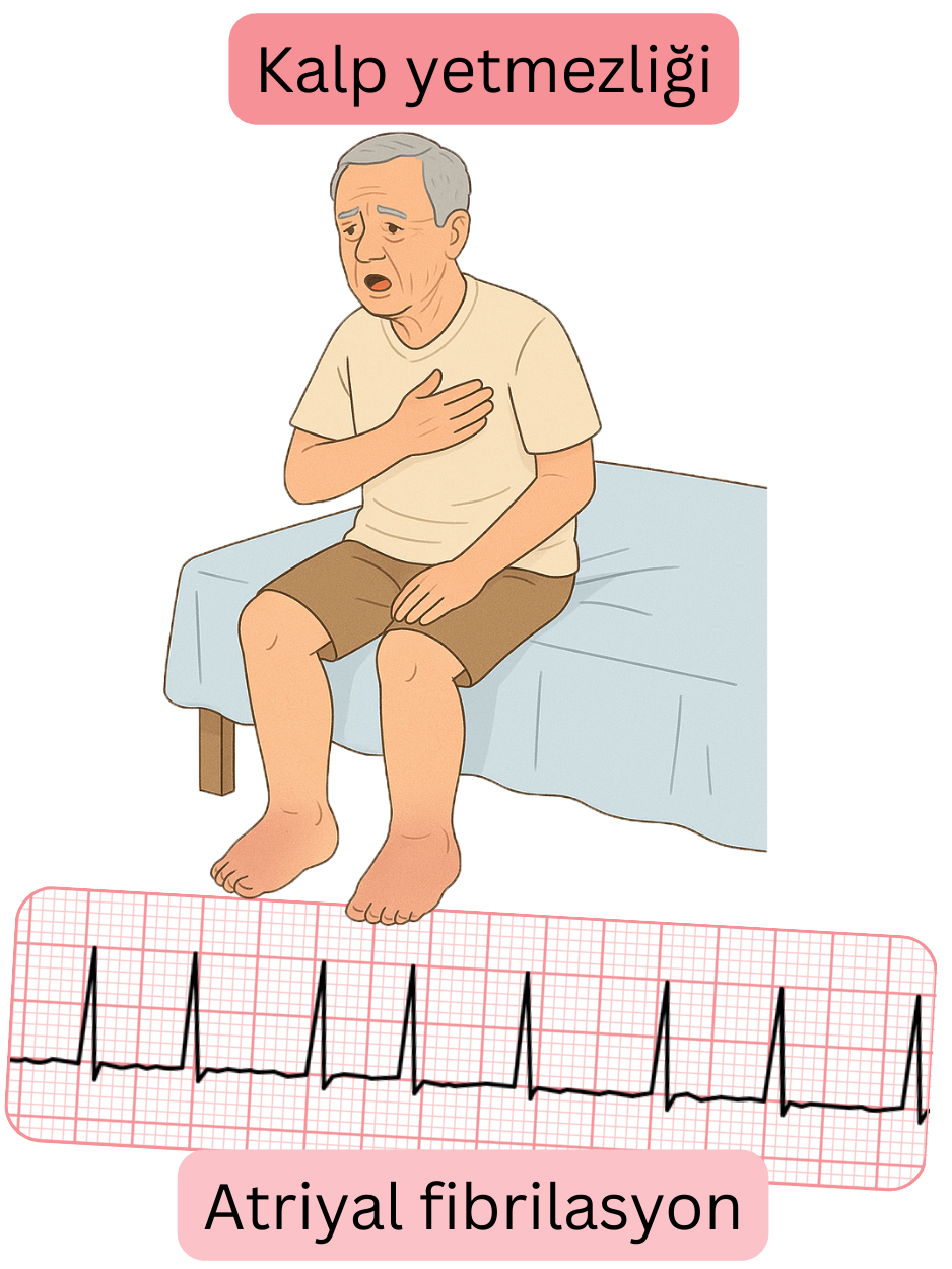 Kalp yetersizliğini atriyal fibrilasyonun önemli bir komorbiditesi olarak ve aritminin EKG kaydını gösteren illüstrasyon.