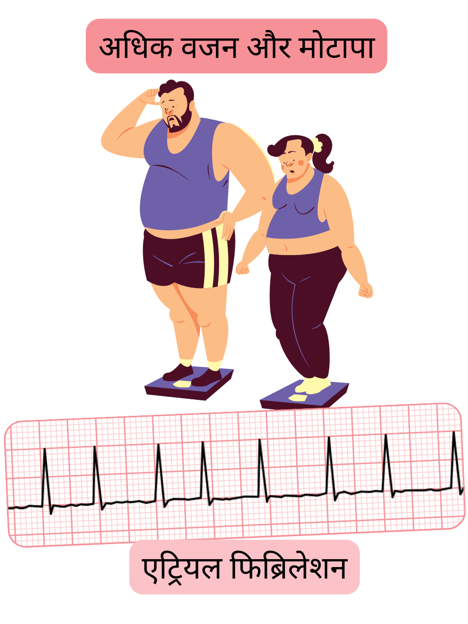 चित्रण जो अधिक वजन और मोटापे को एट्रियल फिब्रिलेशन के महत्वपूर्ण जोखिम कारक के रूप में दर्शाता है, साथ में अतालता का ईसीजी रिकॉर्ड।