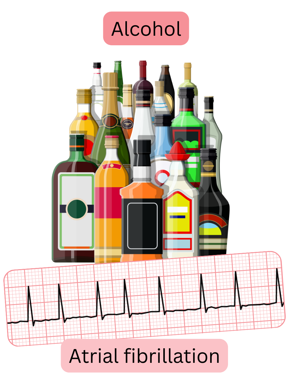 Illustration depicting excessive alcohol consumption as a significant risk factor for atrial fibrillation with an ECG recording of the arrhythmia.