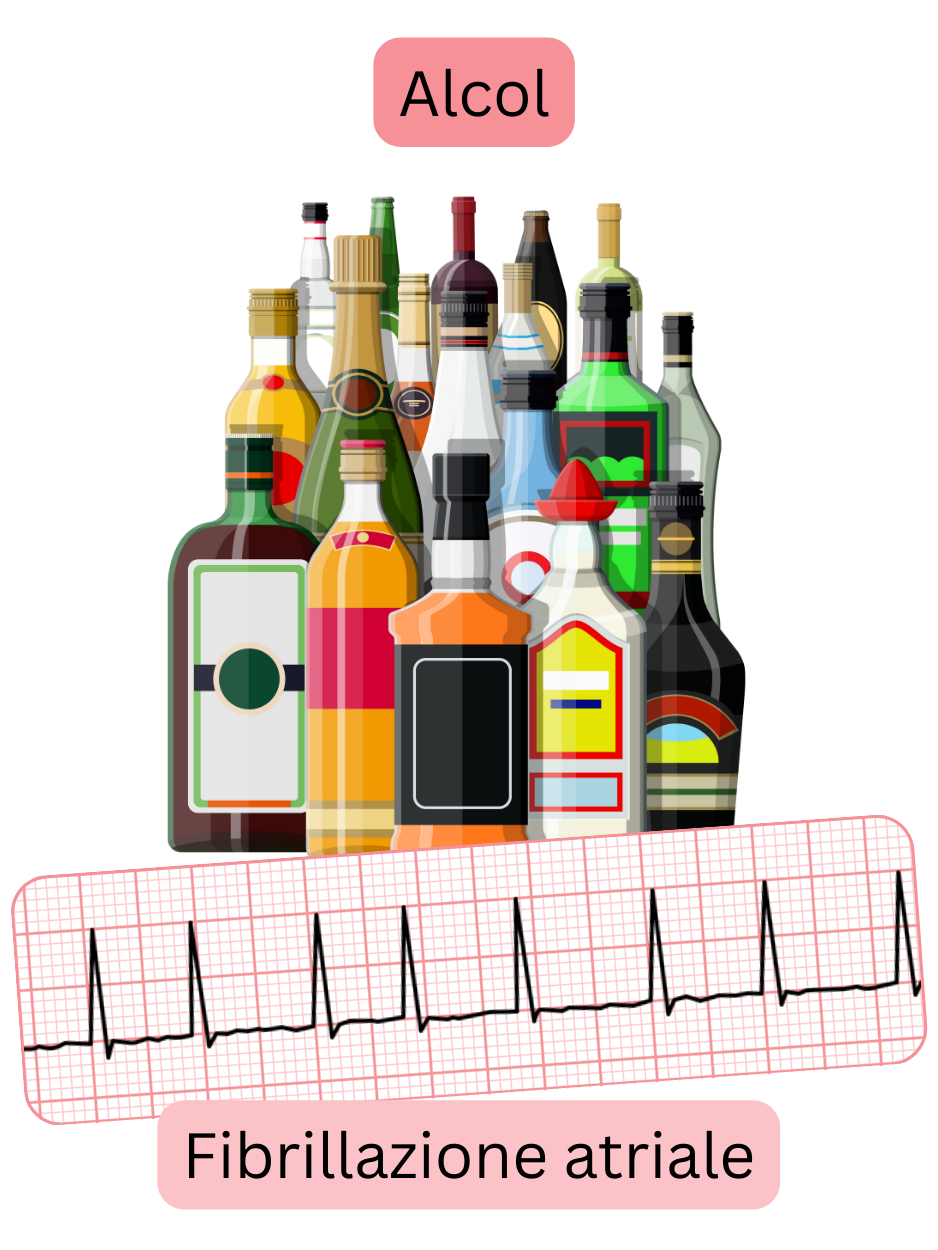 Illustrazione che raffigura il consumo eccessivo di alcol come un importante fattore di rischio per la fibrillazione atriale, con registrazione ECG dell’aritmia.