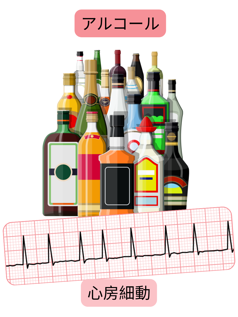 過度のアルコール摂取が心房細動の重要な危険因子であることを、不整脈の心電図記録とともに示す図。