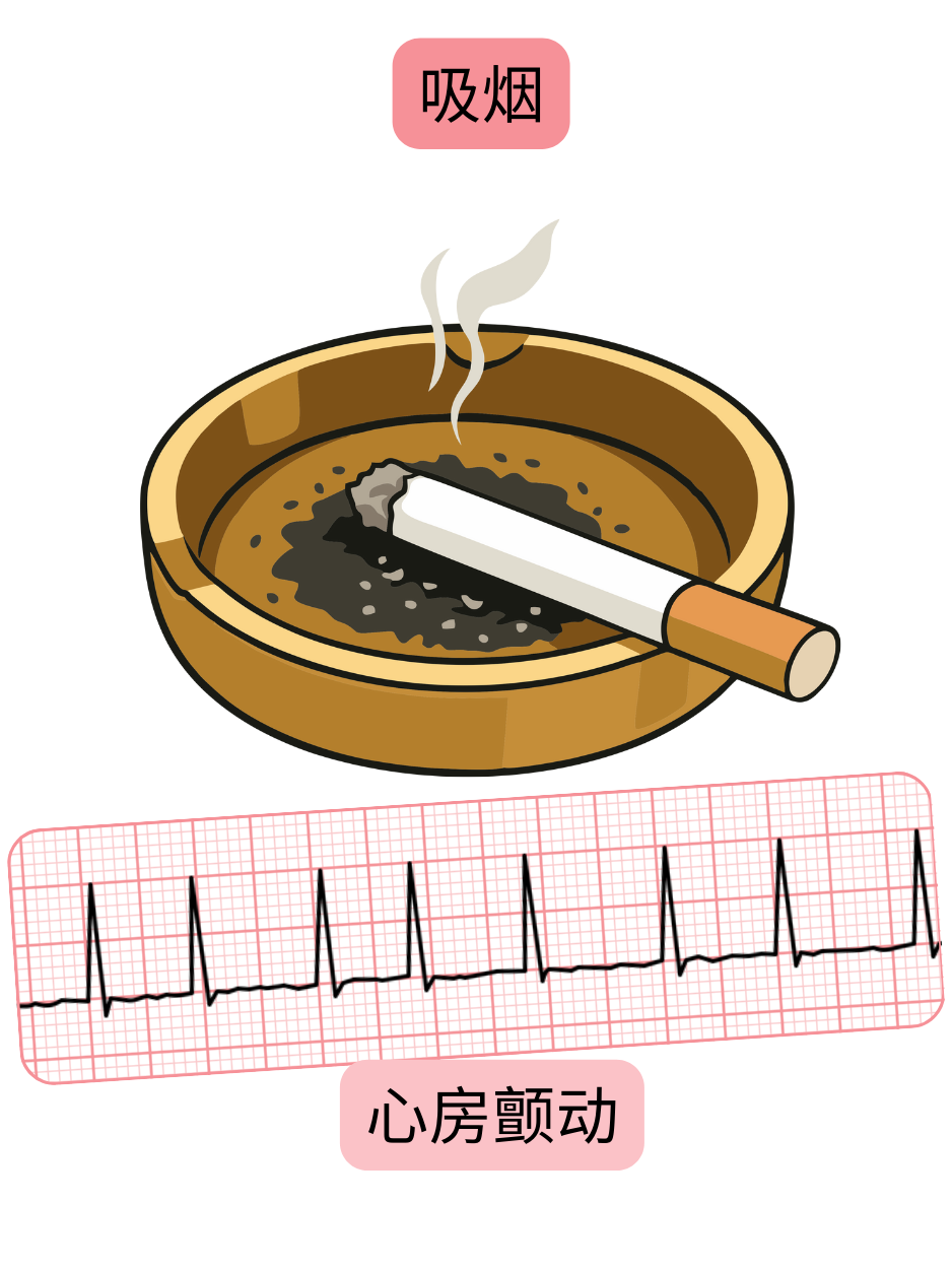 示意图展示吸烟作为心房颤动的重要危险因素，并附有心律失常的心电图记录。
