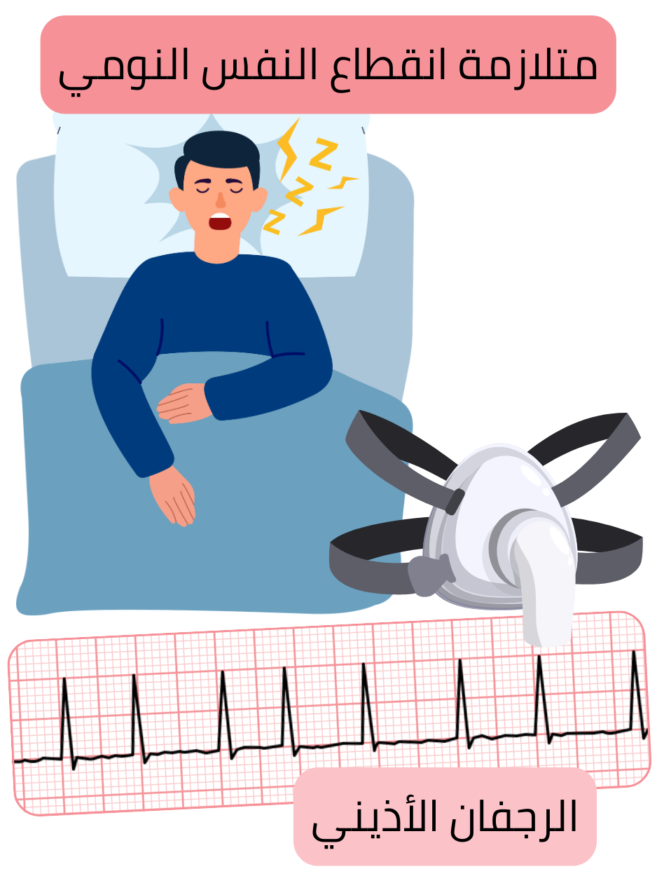 رسم توضيحي يبيّن متلازمة انقطاع النفس أثناء النوم كعامل خطر مهم للرجفان الأذيني مع تسجيل تخطيط القلب لاضطراب النظم.