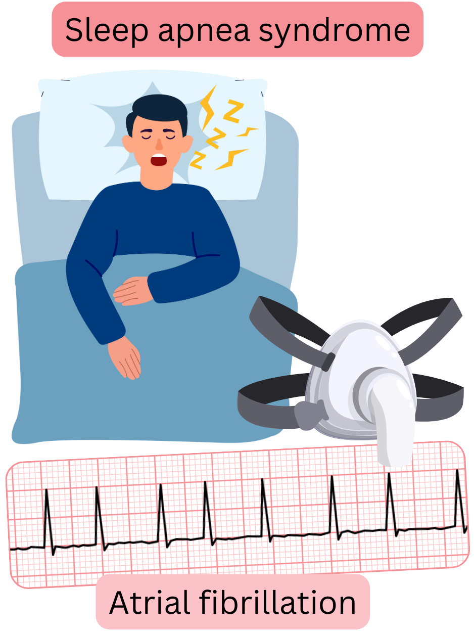 Illustration depicting sleep apnea syndrome as a significant risk factor for atrial fibrillation with an ECG recording of the arrhythmia.