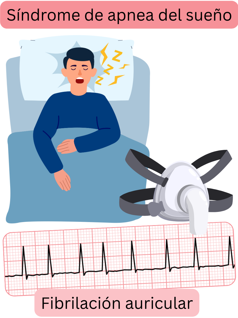 Ilustración que muestra el síndrome de apnea del sueño como un factor de riesgo importante de la fibrilación auricular, con un registro ECG de la arritmia.