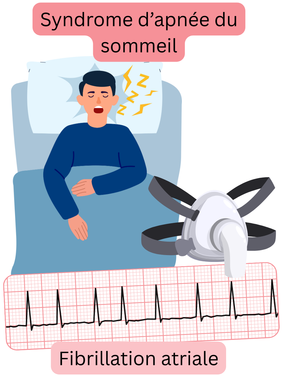 Illustration montrant le syndrome d’apnée du sommeil comme un facteur de risque majeur de la fibrillation atriale, avec un enregistrement ECG de l’arythmie.