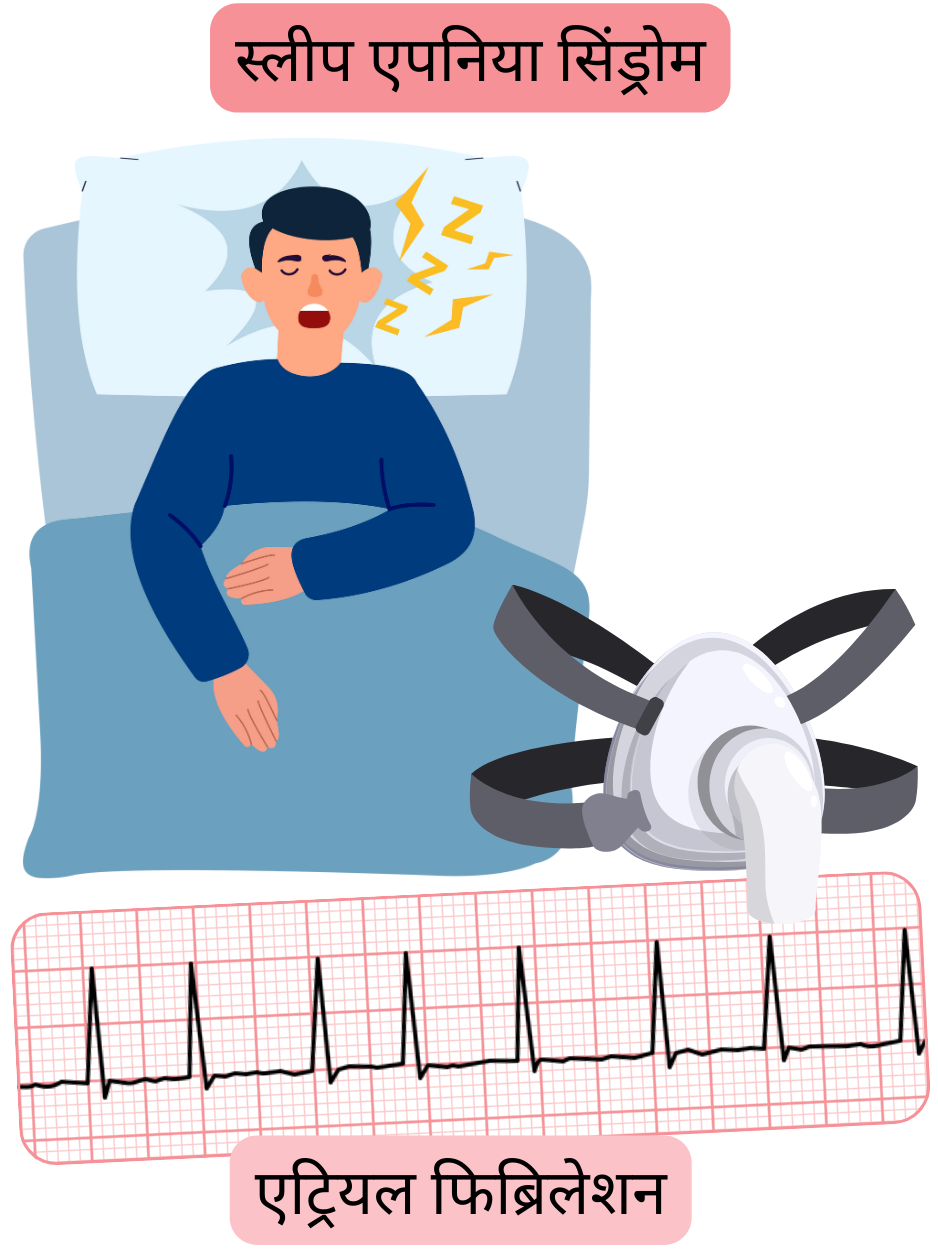 चित्रण जो स्लीप एपनिया सिंड्रोम को एट्रियल फिब्रिलेशन का एक महत्वपूर्ण जोखिम कारक दर्शाता है, साथ में अतालता का ईसीजी रिकॉर्ड।