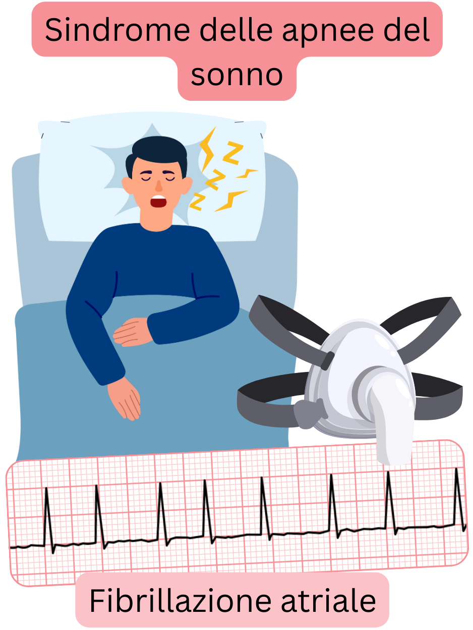 Illustrazione che raffigura la sindrome delle apnee ostruttive del sonno come un importante fattore di rischio per la fibrillazione atriale, con registrazione ECG dell’aritmia.
