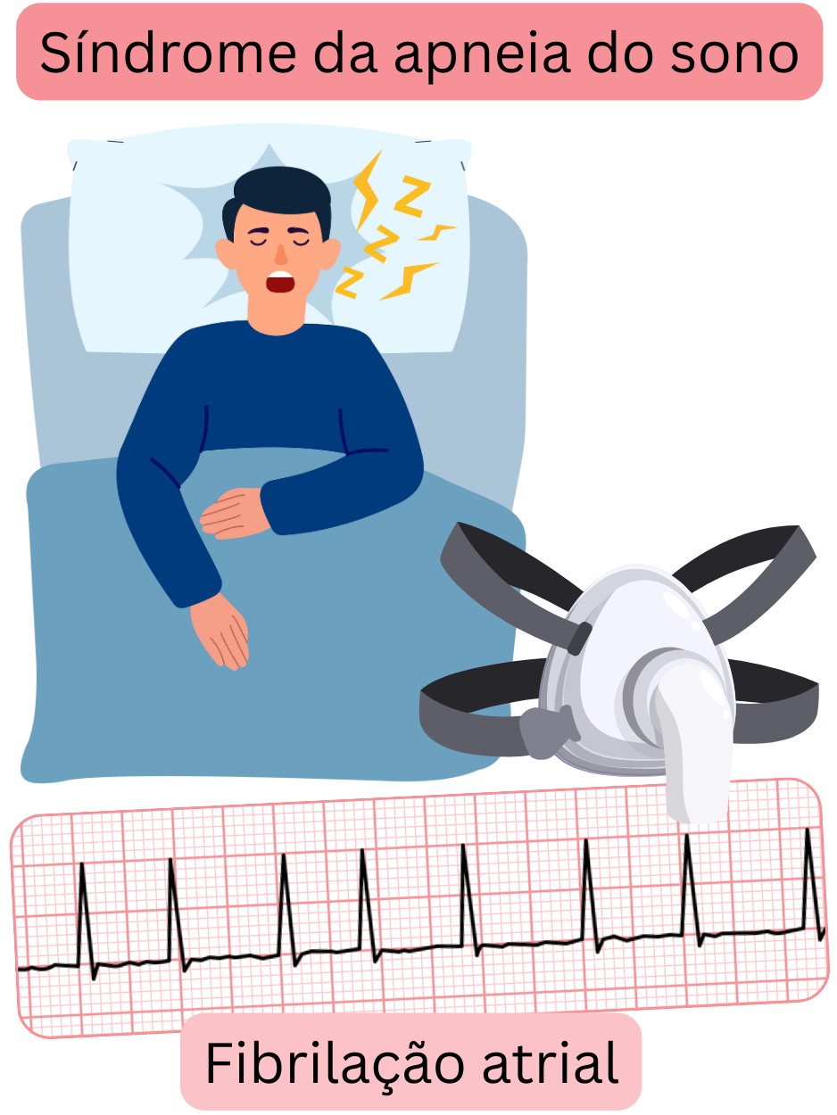 Ilustração que mostra a síndrome da apneia do sono como um fator de risco significativo para a fibrilação atrial, com registo ECG da arritmia.