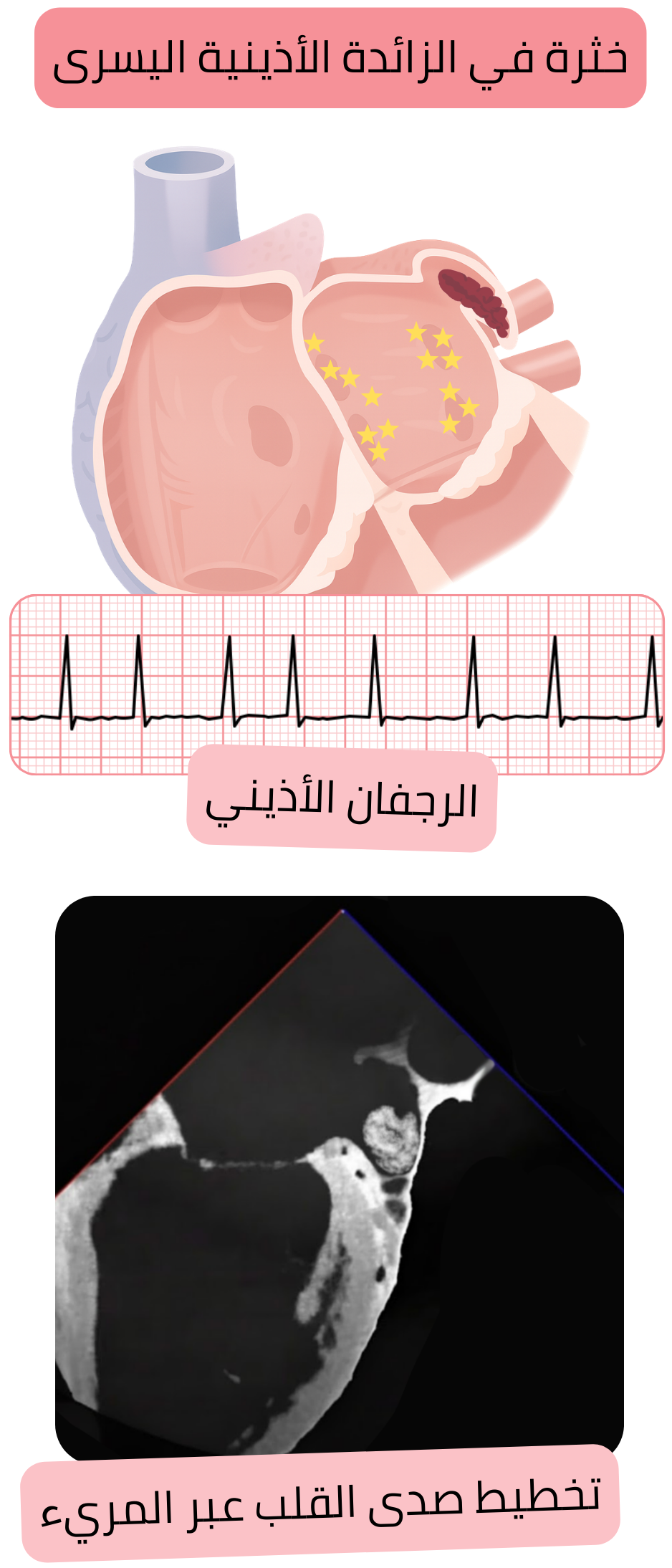 رسم توضيحي لخثرة في زائدة الأذين الأيسر لدى مريض مصاب بالرجفان الأذيني مؤكدة بواسطة تخطيط صدى القلب عبر المريء.