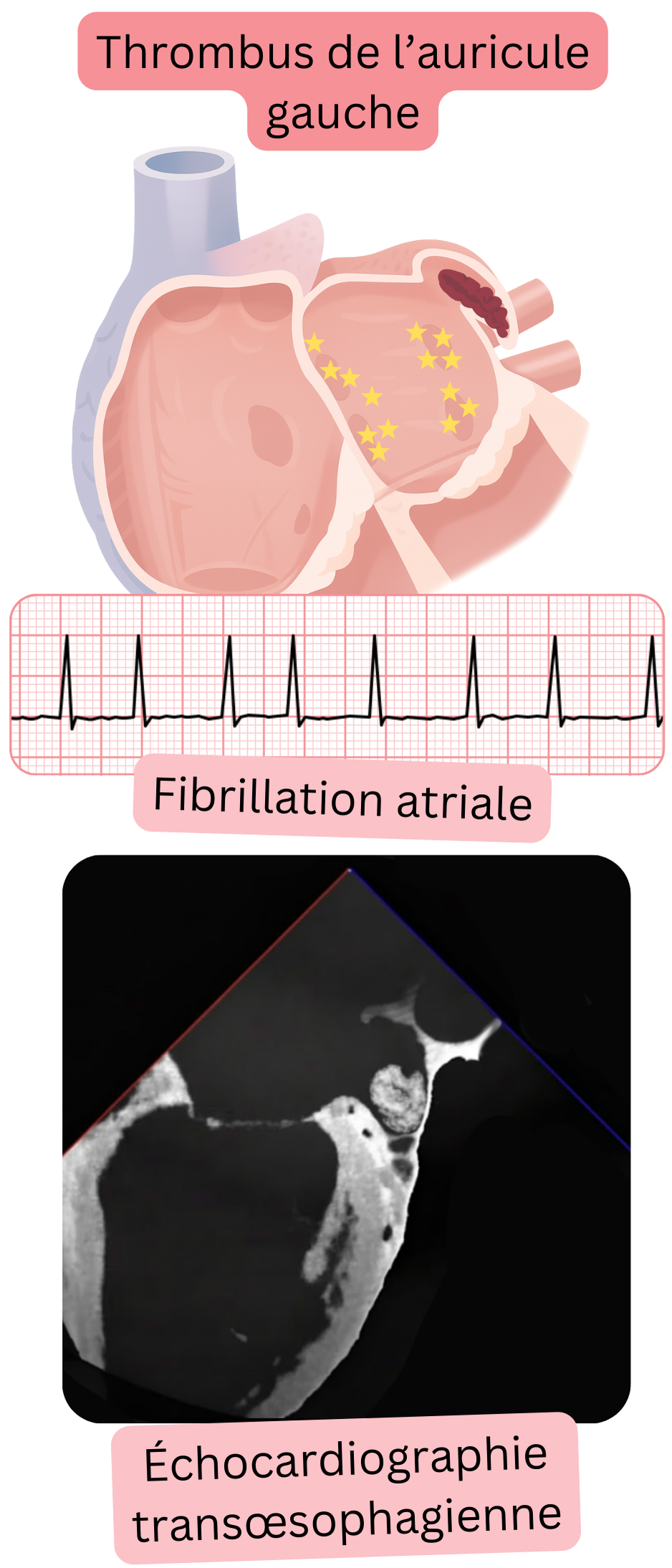 Illustration d’un thrombus de l’appendice auriculaire gauche dans la fibrillation atriale confirmé par échocardiographie transœsophagienne.