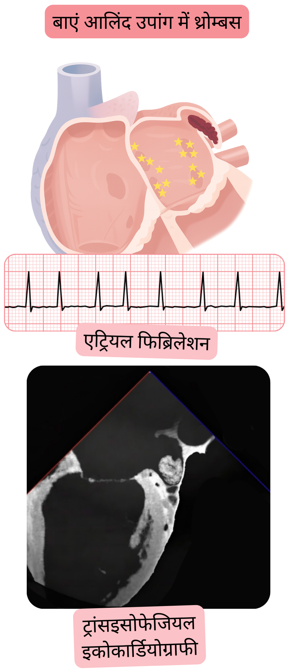 चित्रण जो ट्रांसईसोफेजियल इकोकार्डियोग्राफी द्वारा पुष्टि किए गए एट्रियल फिब्रिलेशन में बाएँ एट्रियल एपेंडेज के थ्रोम्बस को दर्शाता है।