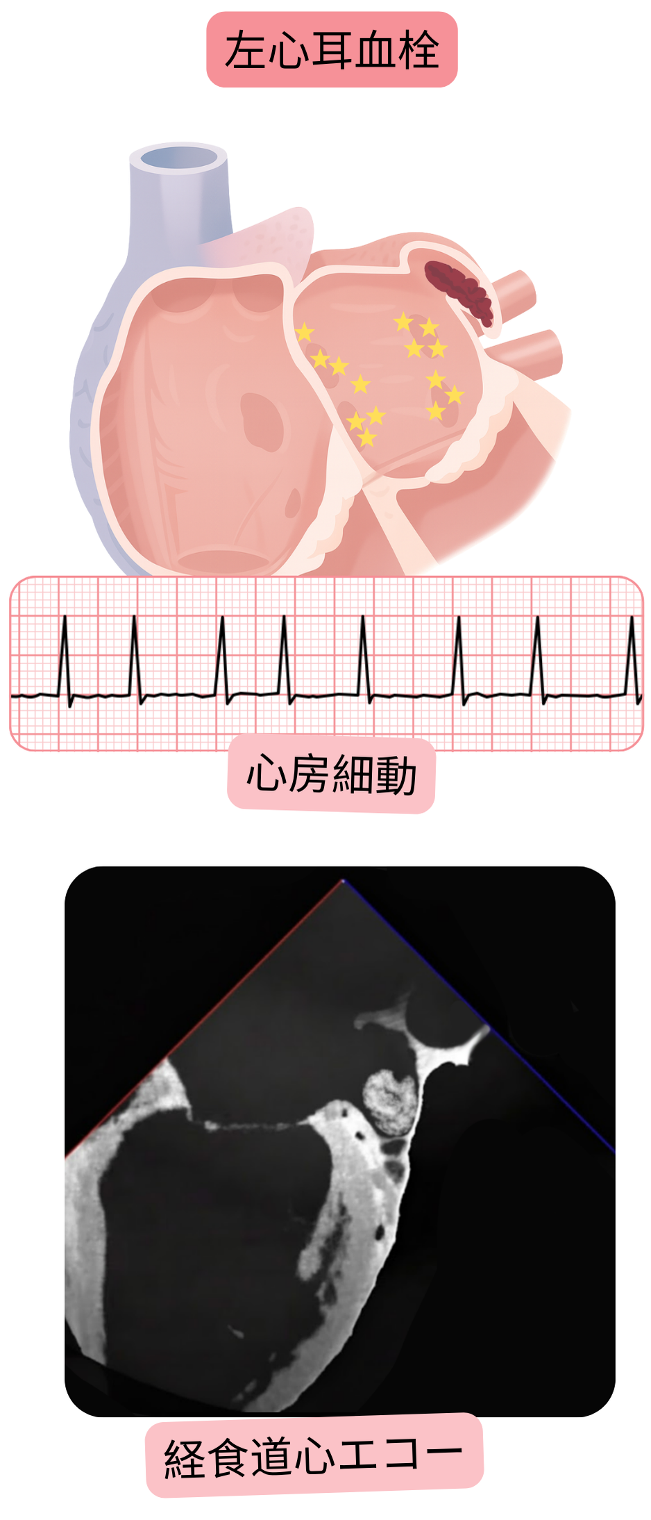 経食道心エコーで確認された、心房細動における左心耳血栓を示す図。