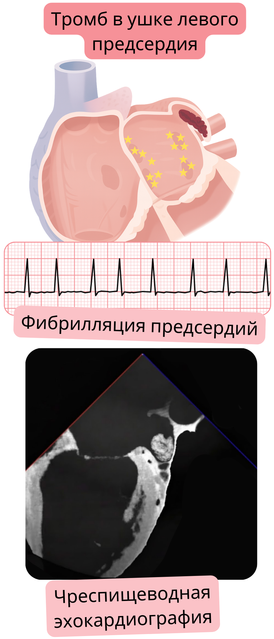 Иллюстрация тромба в ушке левого предсердия при фибрилляции предсердий, подтверждённого чреспищеводной эхокардиографией.