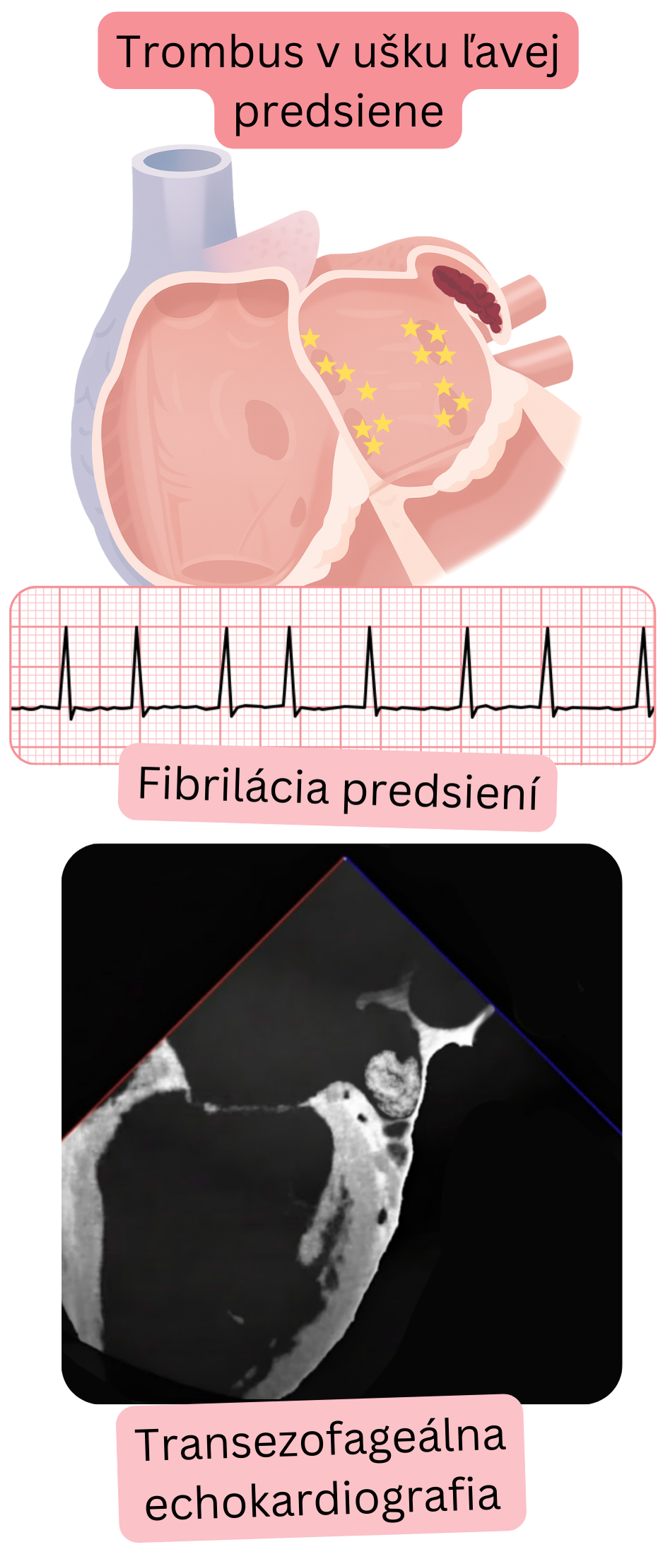 Ilustrácia trombu v ušku ľavej predsiene pri fibrilácii predsiení potvrdeného transezofageálnou echokardiografiou.