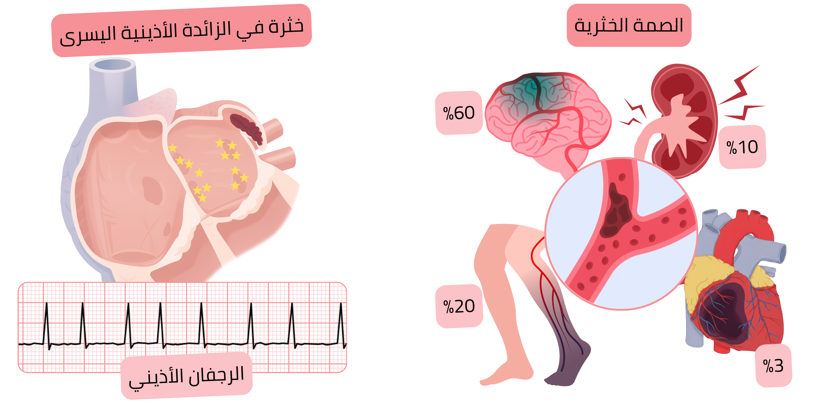 رسم توضيحي يُظهر خثرة في زائدة الأذين الأيسر في الرجفان الأذيني وعلاقتها بالمضاعفات الخثارية الصمية بما في ذلك السكتة الدماغية الإقفارية والصمة المحيطية.