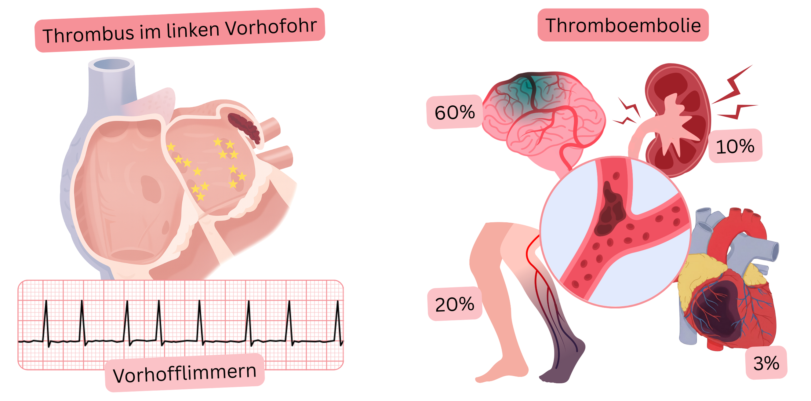 Illustration eines Thrombus im linken Vorhofohr bei Vorhofflimmern und dessen Zusammenhang mit thromboembolischen Komplikationen einschließlich ischämischem Schlaganfall und peripherer Embolie.