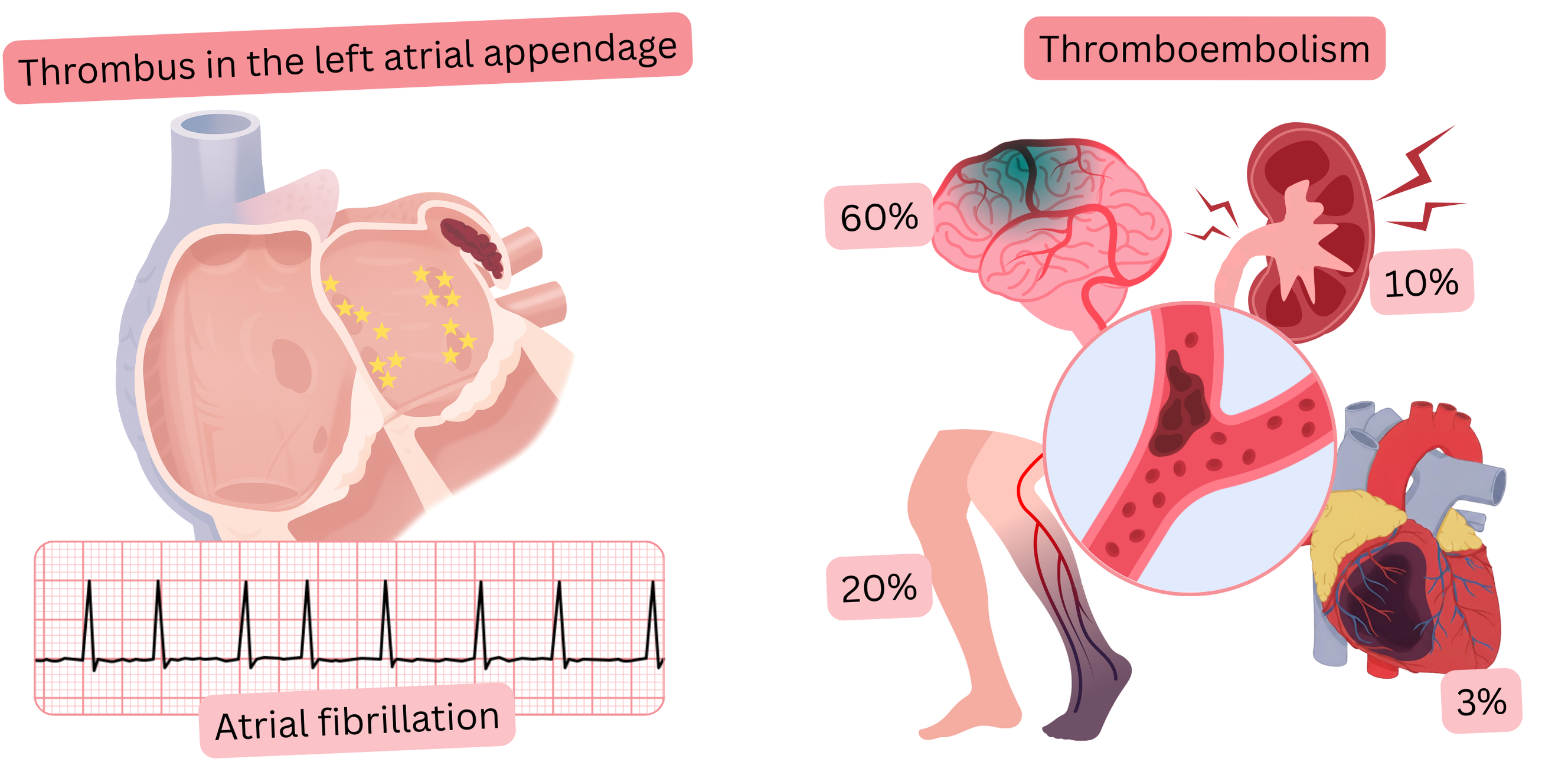 Illustration depicting a thrombus in the left atrial appendage in atrial fibrillation and its association with thromboembolic complications including ischemic stroke and peripheral embolism.