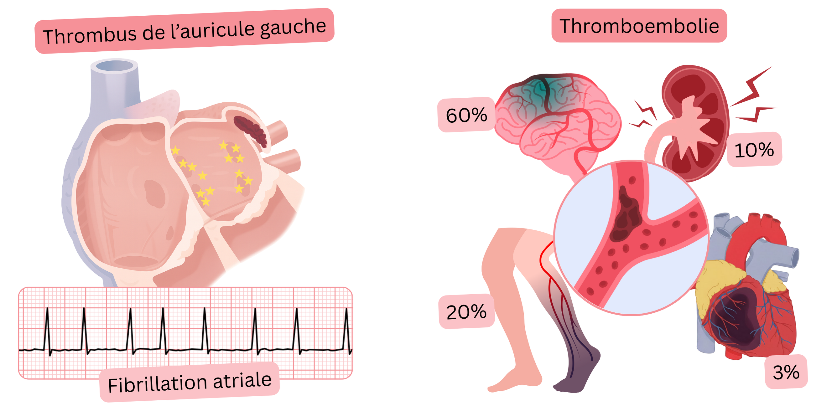 Illustration montrant un thrombus dans l’appendice auriculaire gauche en cas de fibrillation atriale et son lien avec les complications thromboemboliques, notamment l’accident vasculaire cérébral ischémique et l’embolie périphérique.