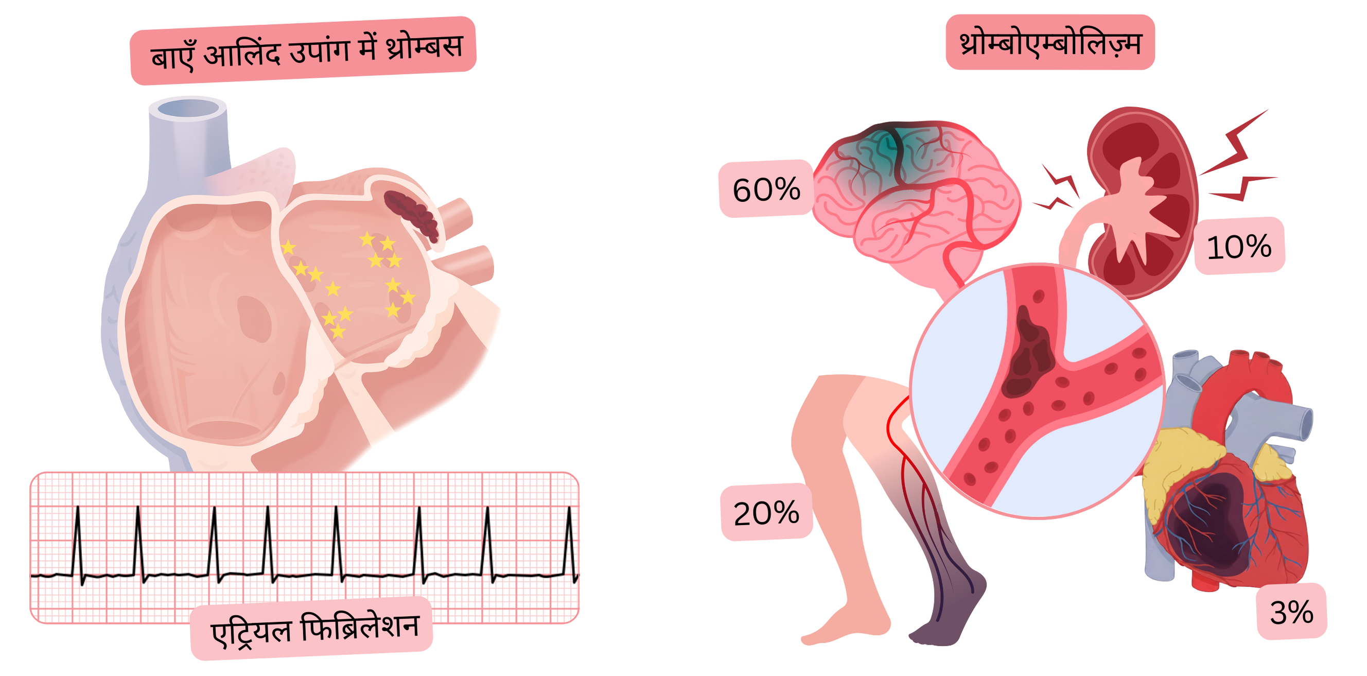 यह चित्र एट्रियल फिब्रिलेशन में बाएं आलिंद उपांग में थ्रोम्बस तथा इसके थ्रोम्बोएम्बोलिक जटिलताओं, जिनमें इस्केमिक स्ट्रोक और परिधीय एम्बोलिज़्म शामिल हैं, के संबंध को दर्शाता है।