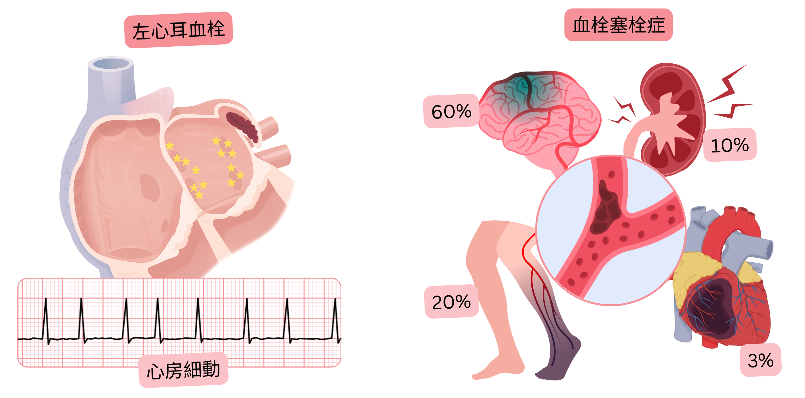心房細動における左心耳血栓と、虚血性脳卒中や末梢塞栓症を含む血栓塞栓性合併症との関連を示すイラスト。