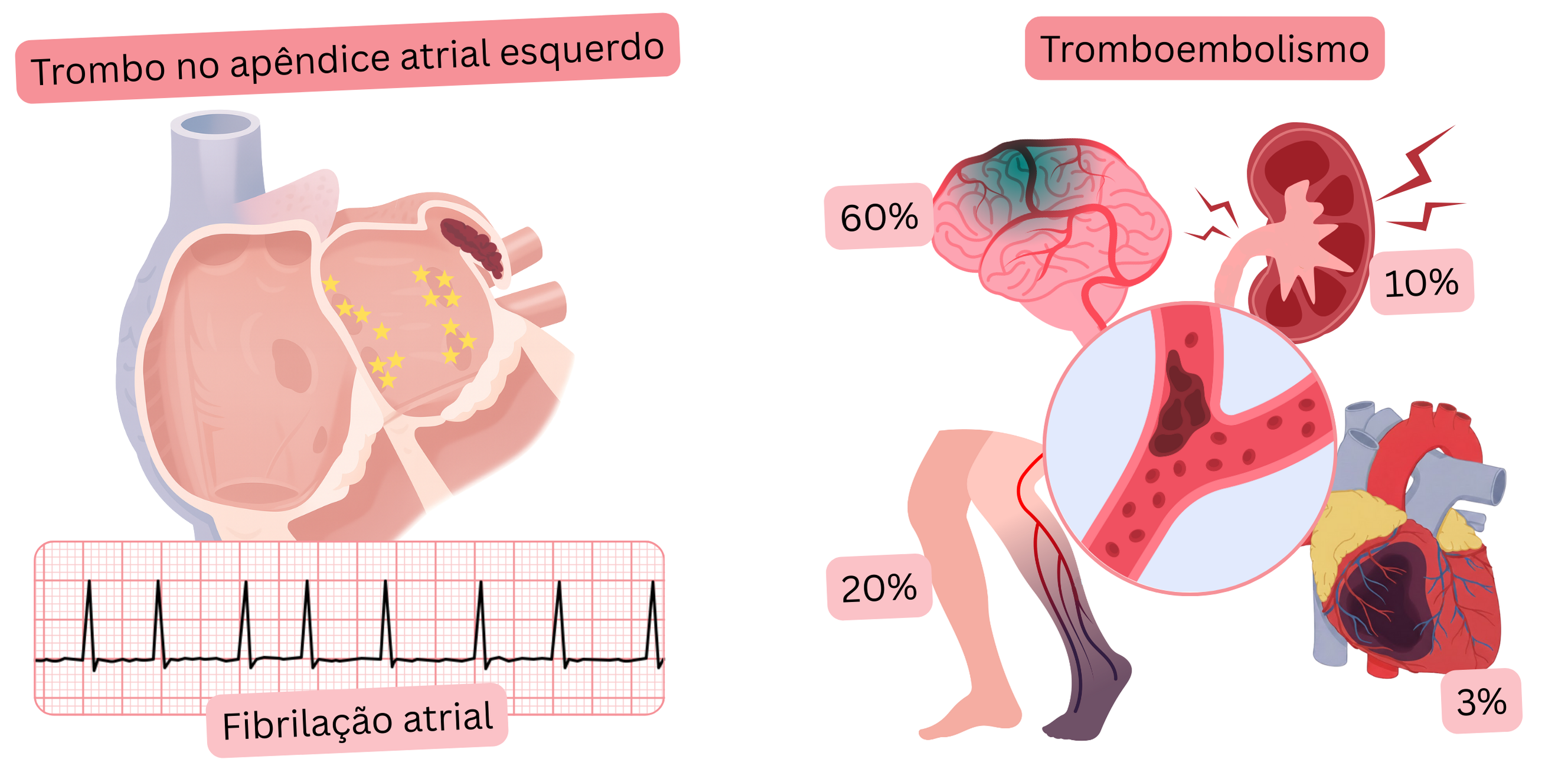 Ilustração que mostra um trombo no apêndice atrial esquerdo na fibrilação atrial e sua associação com complicações tromboembólicas, incluindo acidente vascular cerebral isquêmico e embolia periférica.