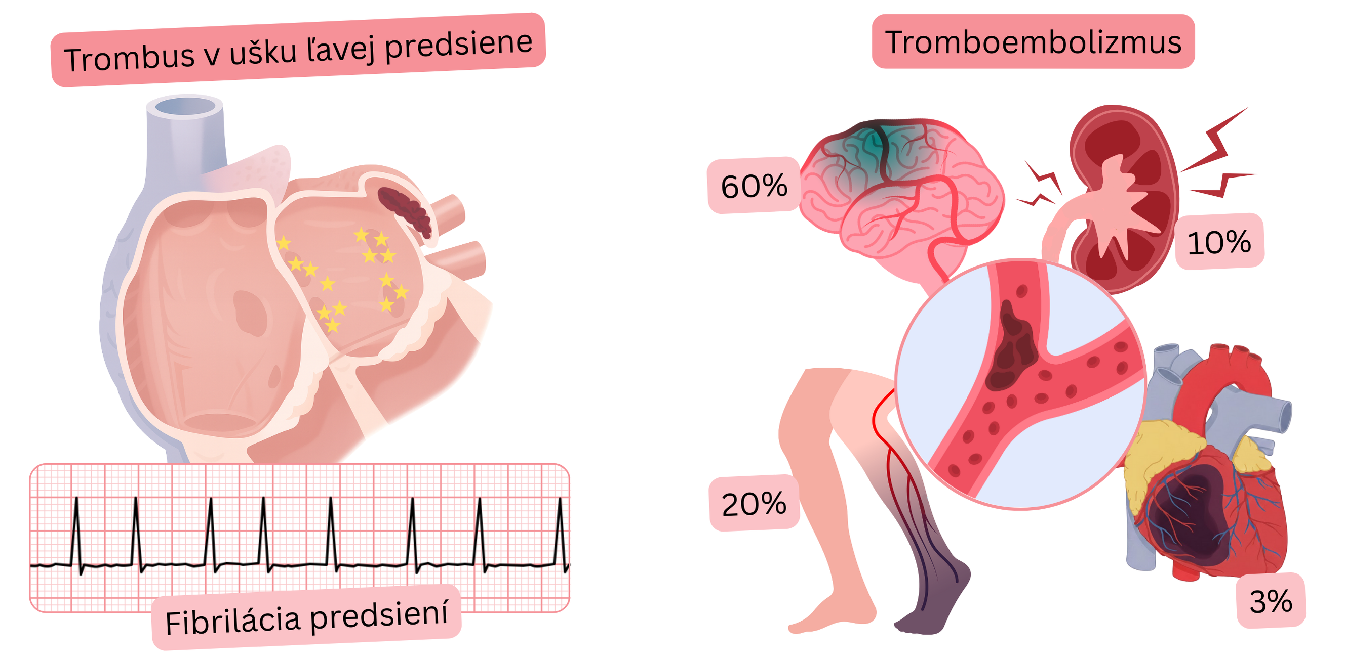 Ilustrácia zobrazujúca trombus v ušku ľavej predsiene pri fibrilácii predsiení a jeho vzťah k tromboembolickým komplikáciám vrátane ischemickej cievnej mozgovej príhody a periférnej embólie.