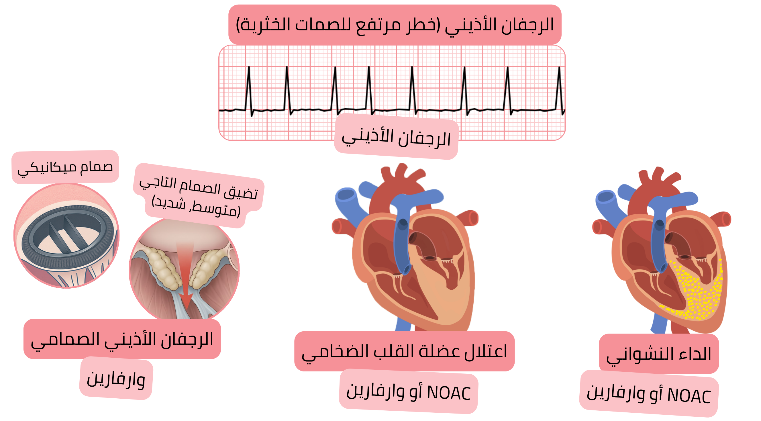 إنفوجرافيك يوضح درجة CHA₂DS₂-VA مع عوامل الخطر الفردية وعلاقتها بخطر السكتة الدماغية الإقفارية في الرجفان الأذيني.