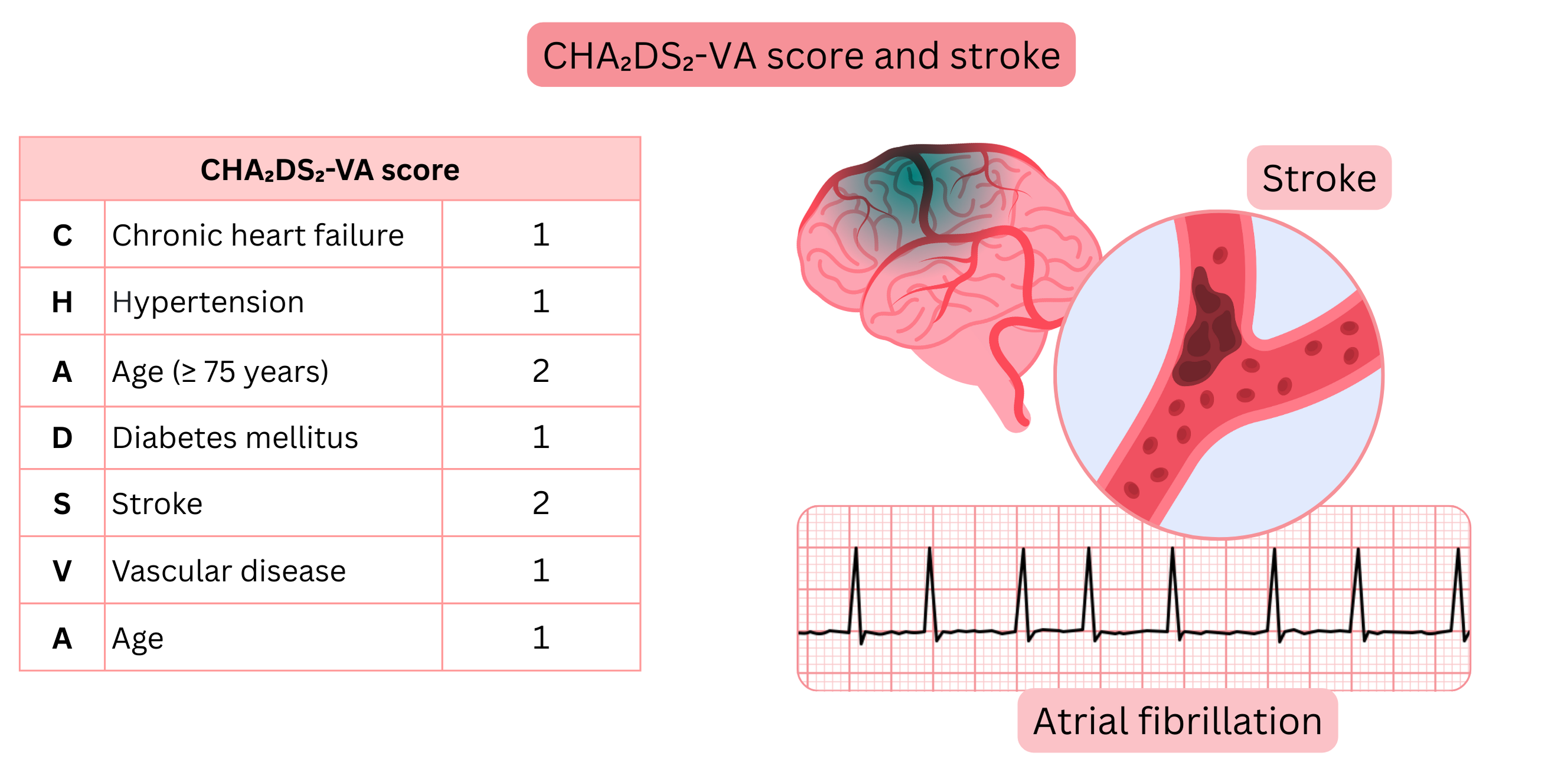 Infographic illustrating the CHA₂DS₂-VA score with individual risk factors and its relationship to the risk of ischemic stroke in atrial fibrillation.
