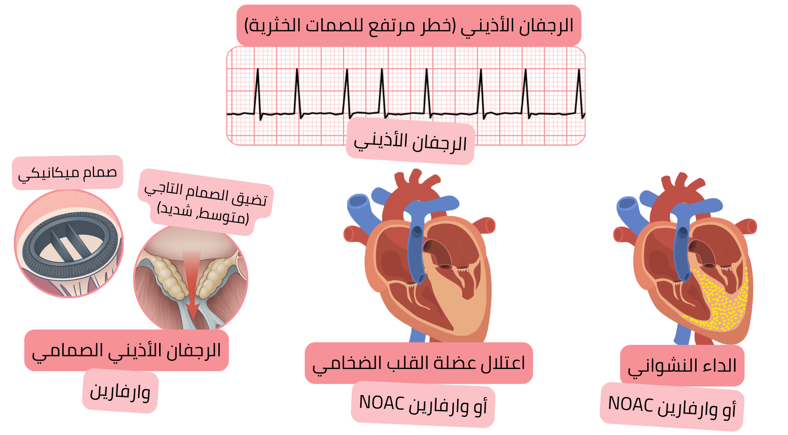 إنفوجرافيك يوضح الرجفان الأذيني عالي الخطورة للخثار الصمي في الرجفان الأذيني الصمامي واعتلال عضلة القلب الضخامي والداء النشواني، مع توصية بالعلاج المضاد للتخثر باستخدام الوارفارين أو مضادات التخثر الفموية الحديثة.