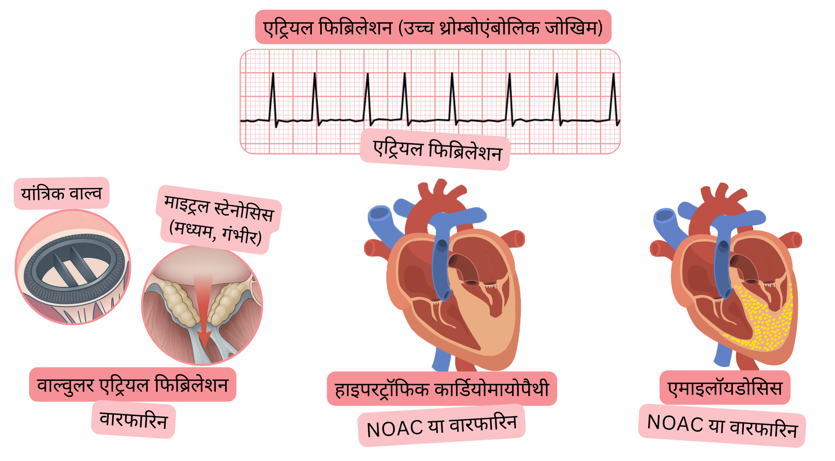 यह इन्फोग्राफिक वाल्वुलर एट्रियल फिब्रिलेशन, हाइपरट्रॉफिक कार्डियोमायोपैथी और अमाइलॉइडोसिस में उच्च थ्रोम्बोएम्बोलिक जोखिम वाले एट्रियल फिब्रिलेशन तथा वारफारिन या NOAC से अनुशंसित एंटीकॉगुलेंट उपचार को दर्शाता है।