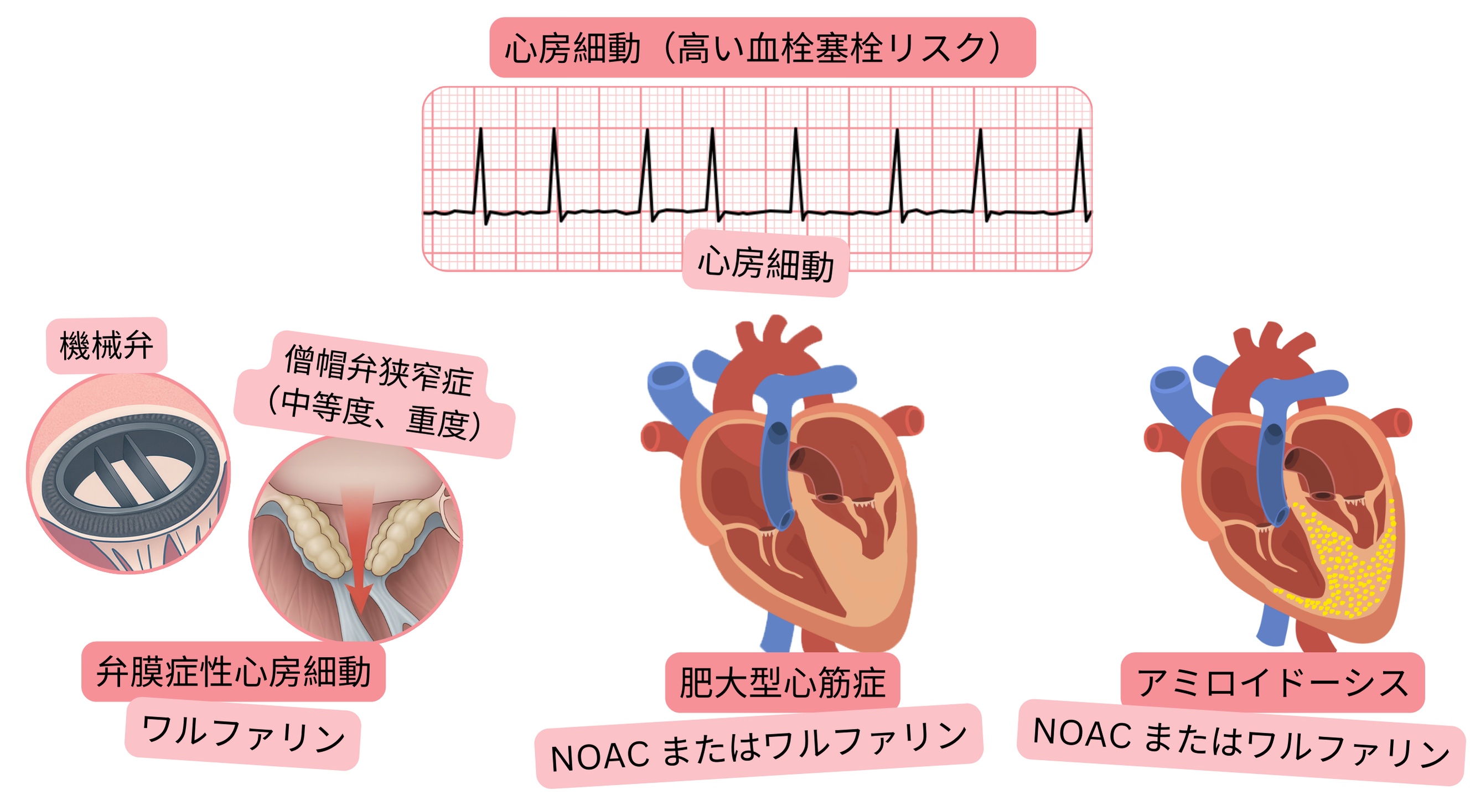 弁膜症性心房細動、肥大型心筋症、アミロイドーシスにおける高血栓塞栓リスクの心房細動と、ワルファリンまたはNOACによる推奨抗凝固療法を示すインフォグラフィック。