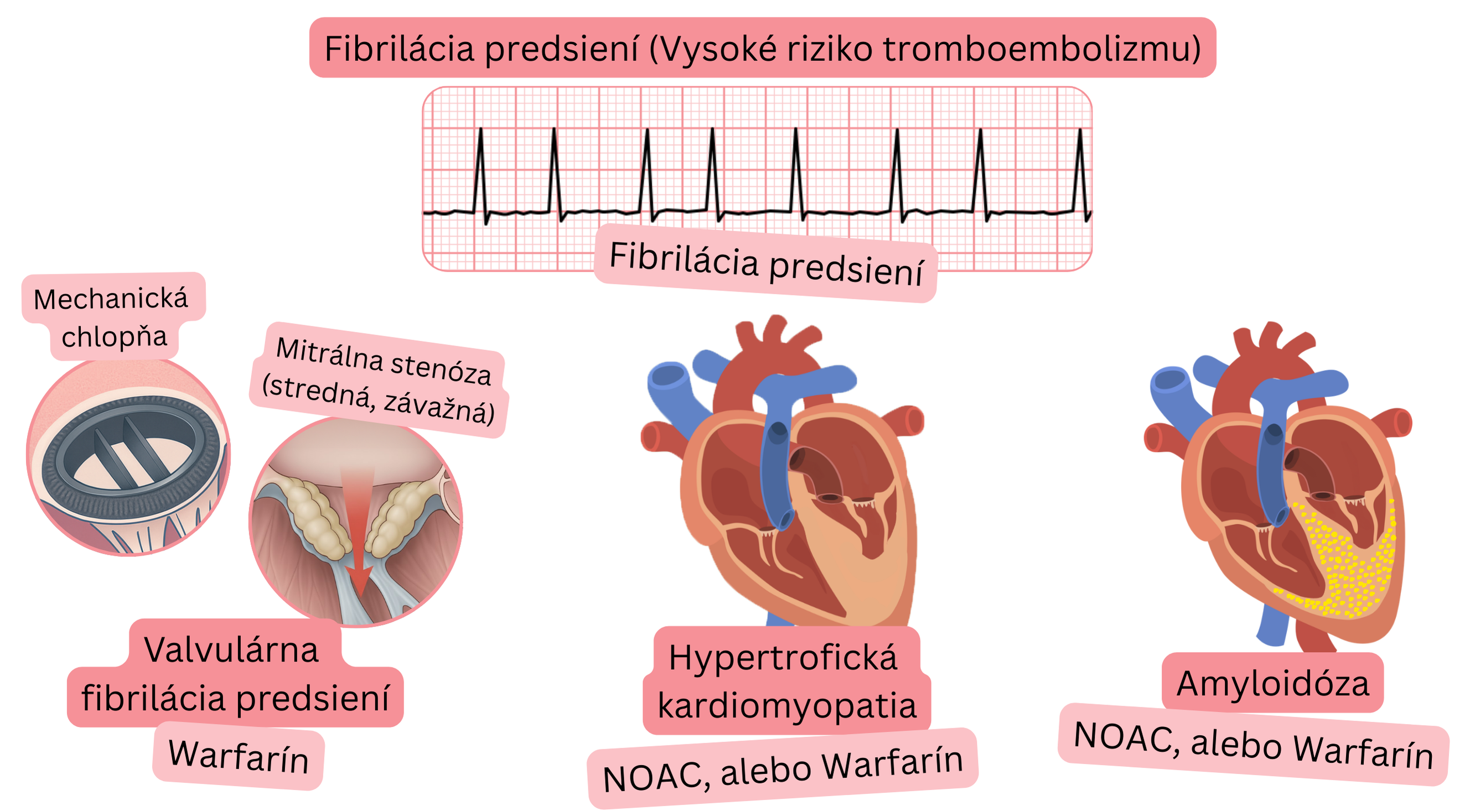 Infografika zobrazujúca fibriláciu predsiení s vysokým rizikom tromboembolizmu pri valvulárnej fibrilácii predsiení, hypertrofickej kardiomyopatii a amyloidóze s odporúčanou antikoagulačnou liečbou warfarínom alebo NOAC.
