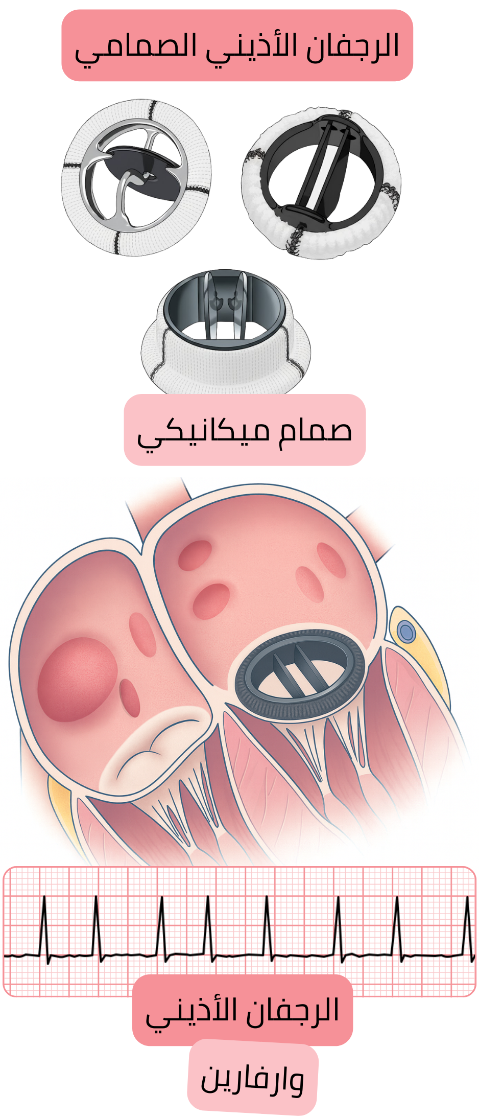 رسم توضيحي للرجفان الأذيني الصمامي لدى مريض بصمام قلبي ميكانيكي مع تسجيل تخطيط القلب للرجفان الأذيني ودواعي العلاج المضاد للتخثر بالوارفارين.
