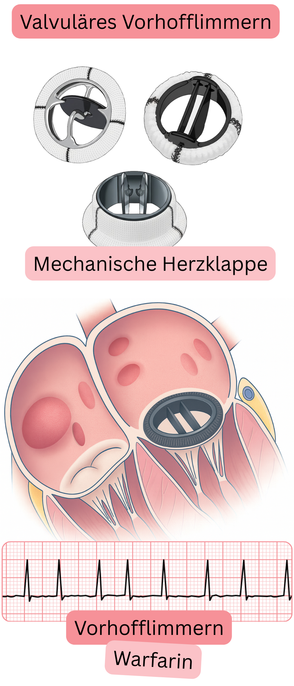 Illustration eines valvulären Vorhofflimmerns bei einem Patienten mit mechanischer Herzklappe mit EKG-Nachweis von Vorhofflimmern und Indikation zur Antikoagulation mit Warfarin.