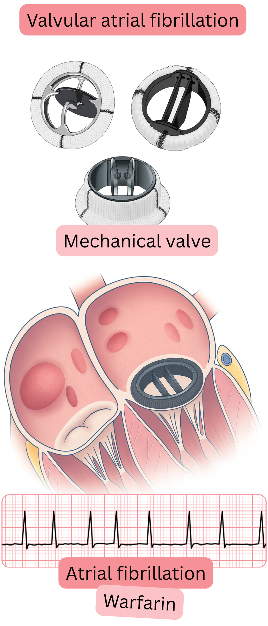 Illustration of valvular atrial fibrillation in a patient with a mechanical heart valve, showing an ECG recording of atrial fibrillation and indication for anticoagulation with warfarin.