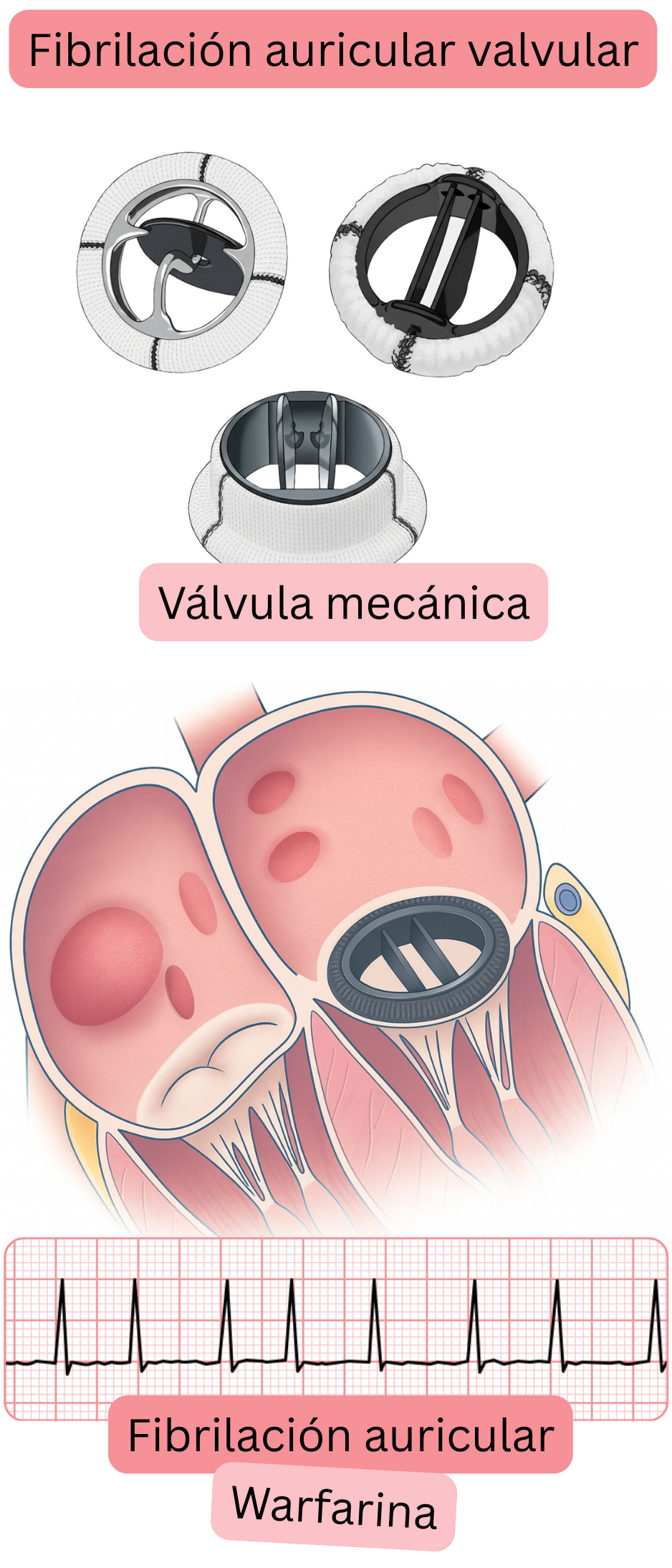 Ilustración de la fibrilación auricular valvular en un paciente con una válvula cardíaca mecánica, con registro ECG de fibrilación auricular e indicación de anticoagulación con warfarina.