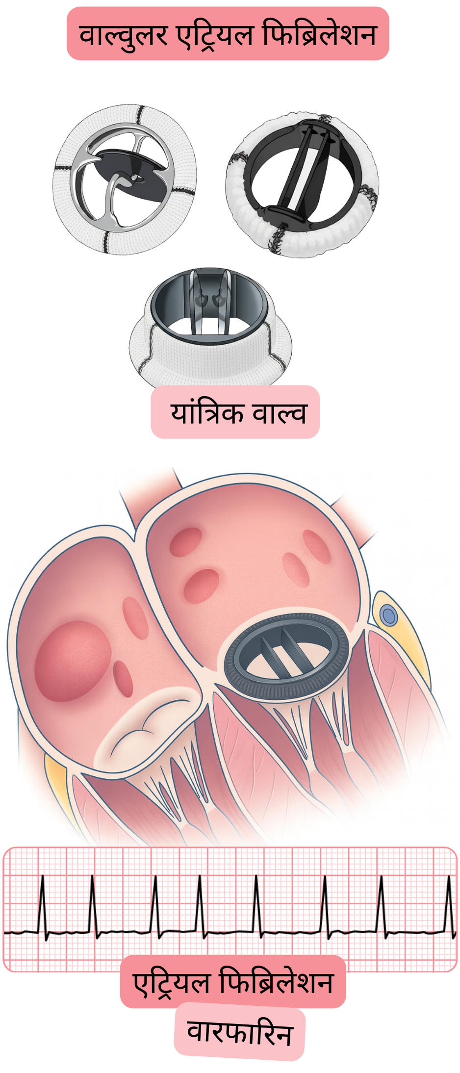 यह चित्र यांत्रिक हृदय वाल्व वाले रोगी में वाल्वुलर एट्रियल फिब्रिलेशन को दर्शाता है, जिसमें एट्रियल फिब्रिलेशन का ईसीजी रिकॉर्ड और वारफारिन से एंटीकॉगुलेंट उपचार की संकेतना शामिल है।