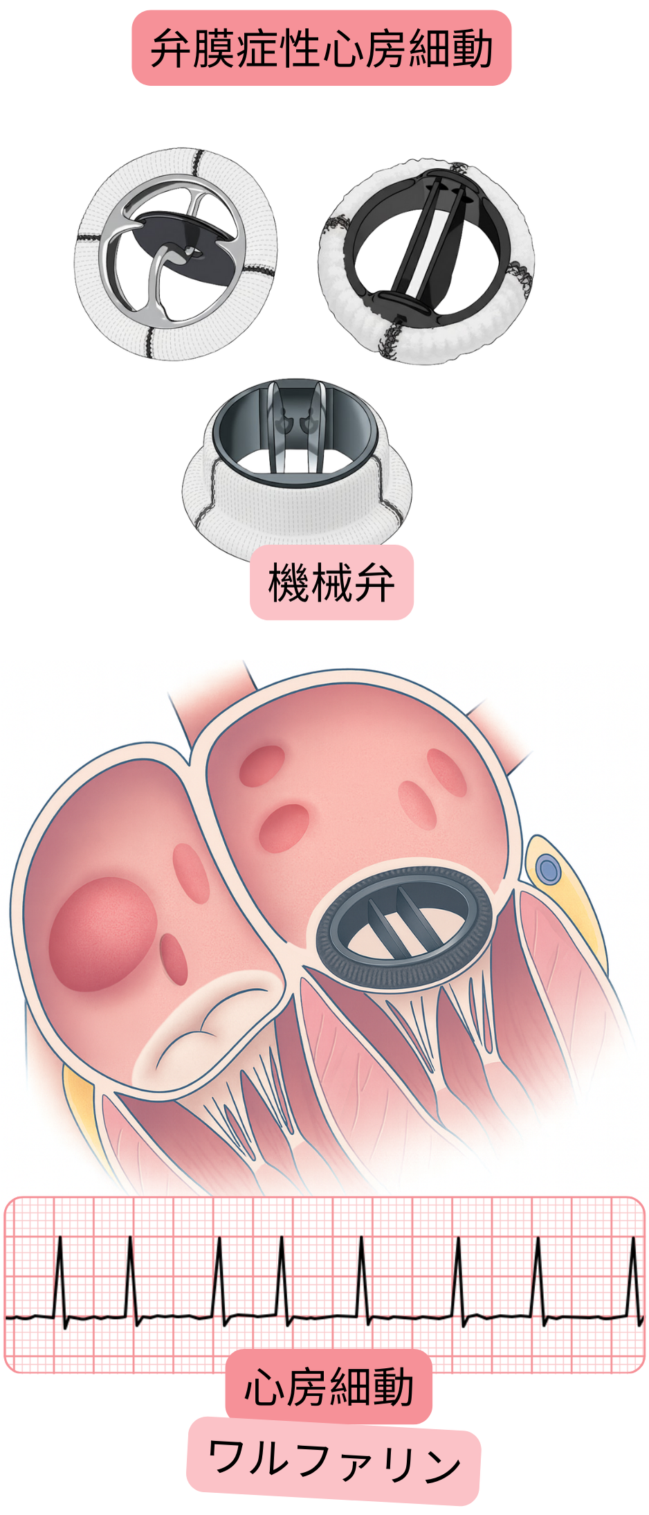 機械弁置換患者における弁膜症性心房細動を示し、心房細動の心電図所見とワルファリンによる抗凝固療法の適応を示したイラスト。