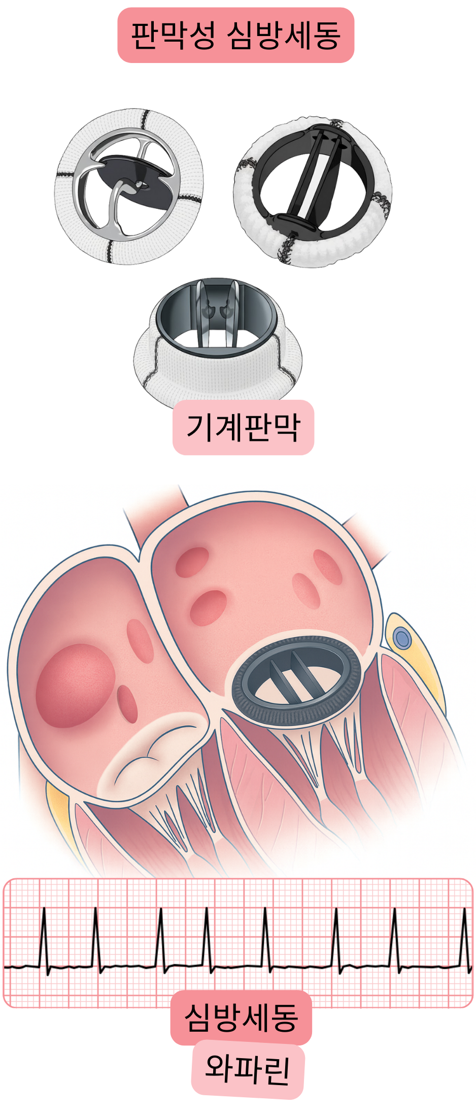 기계식 심장판막 환자에서의 판막성 심방세동을 보여주며, 심방세동의 심전도 기록과 와파린 항응고 치료 적응증을 포함한 그림.