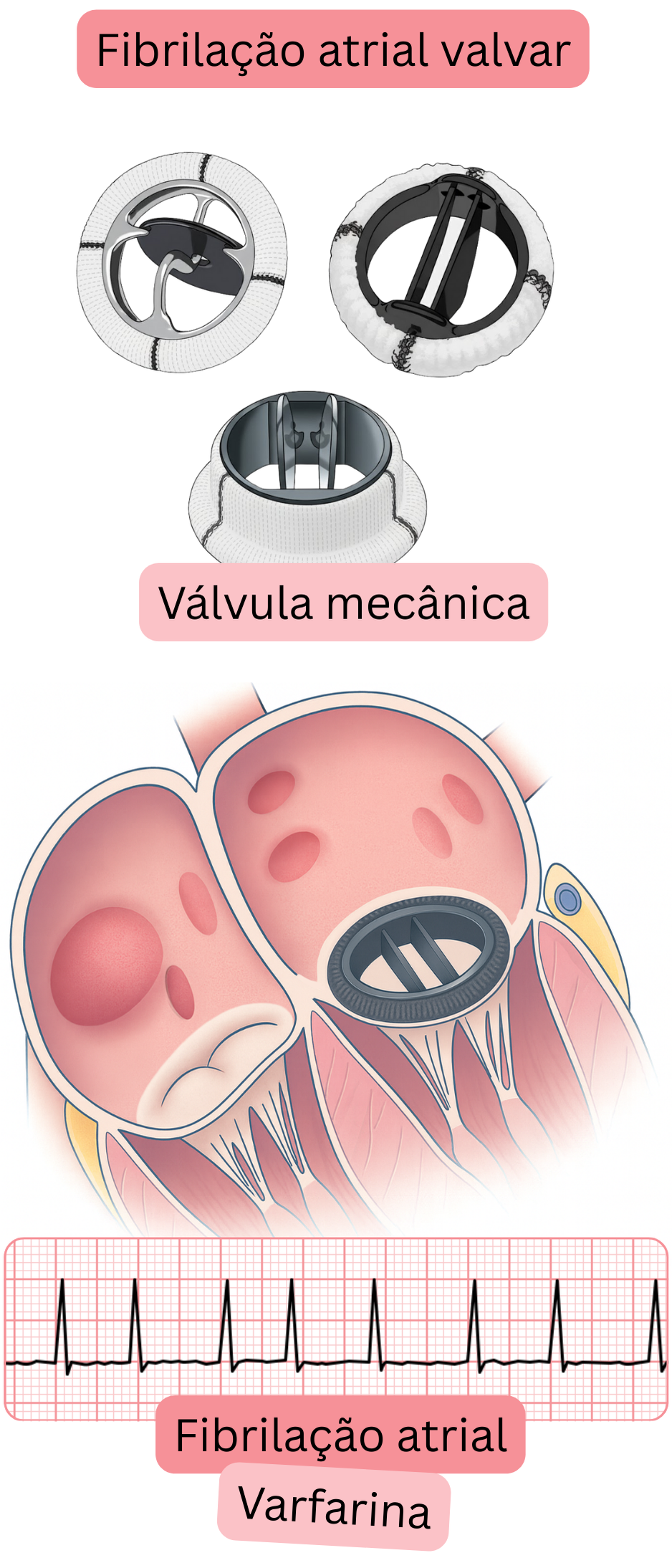 Ilustração da fibrilação atrial valvar em um paciente com válvula cardíaca mecânica, com registro de ECG de fibrilação atrial e indicação de anticoagulação com varfarina.