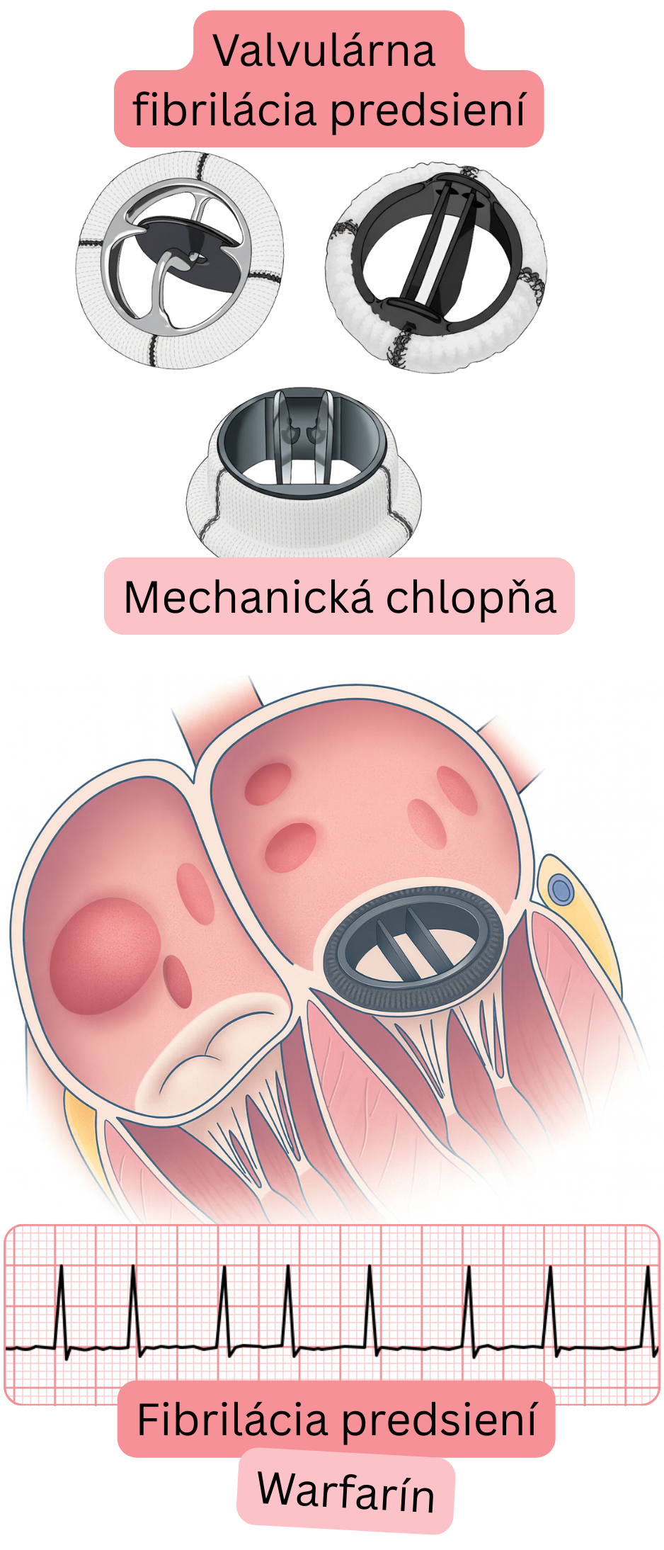 Ilustrácia valvulárnej fibrilácie predsiení u pacienta s mechanickou srdcovou chlopňou s EKG záznamom fibrilácie predsiení a indikáciou antikoagulačnej liečby warfarínom.