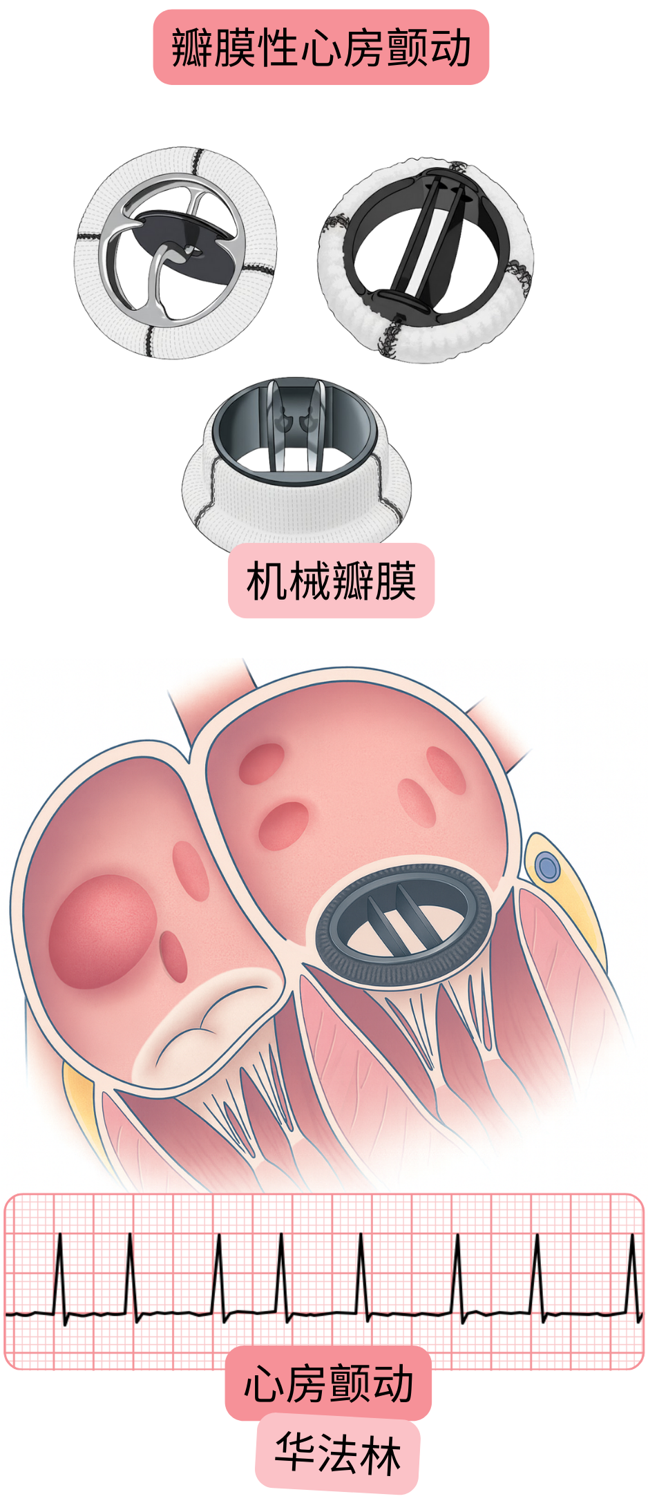 示意图展示机械性心脏瓣膜患者的瓣膜性心房颤动，包含心房颤动的心电图记录及华法林抗凝治疗指征。