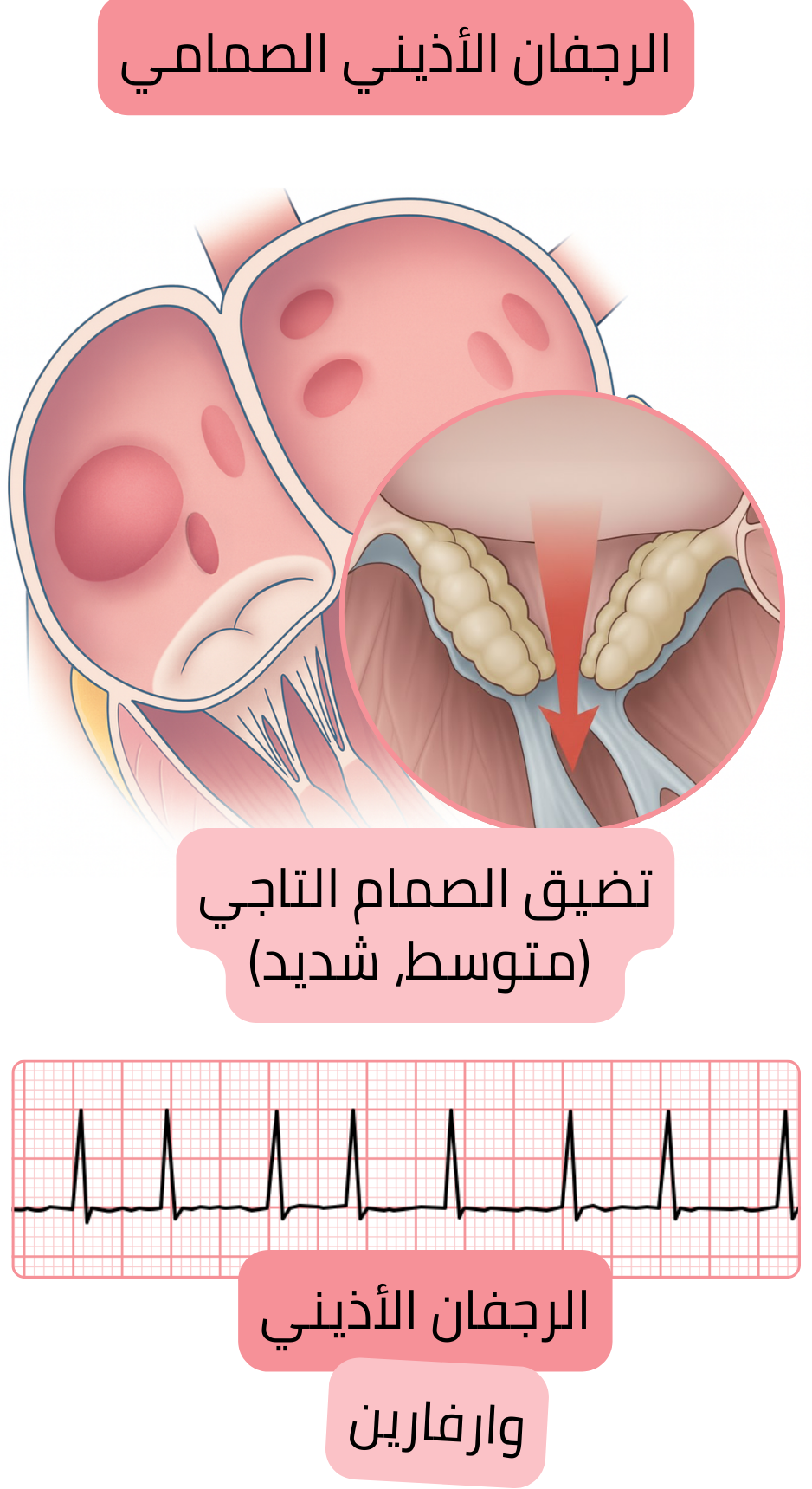 رسم توضيحي للرجفان الأذيني الصمامي في تضيق الصمام التاجي المتوسط إلى الشديد مع تسجيل تخطيط القلب للرجفان الأذيني ودواعي العلاج المضاد للتخثر بالوارفارين.