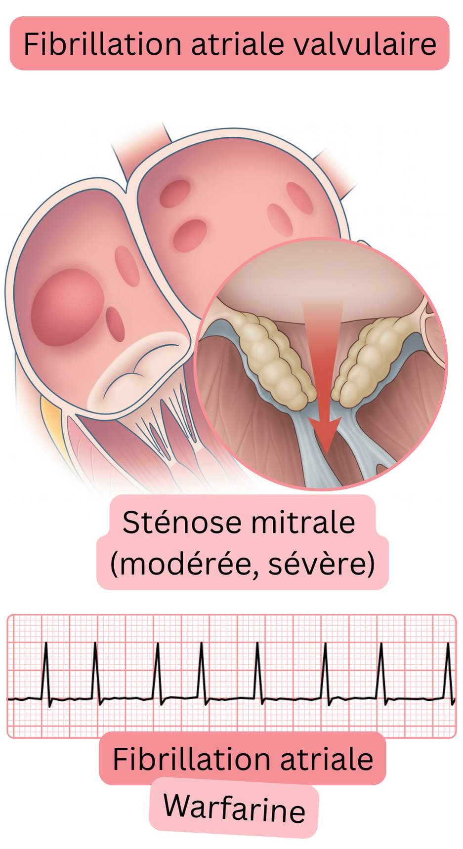 Illustration de la fibrillation atriale valvulaire en cas de sténose mitrale modérée à sévère, avec un tracé ECG de fibrillation atriale et une indication d’anticoagulation par warfarine.